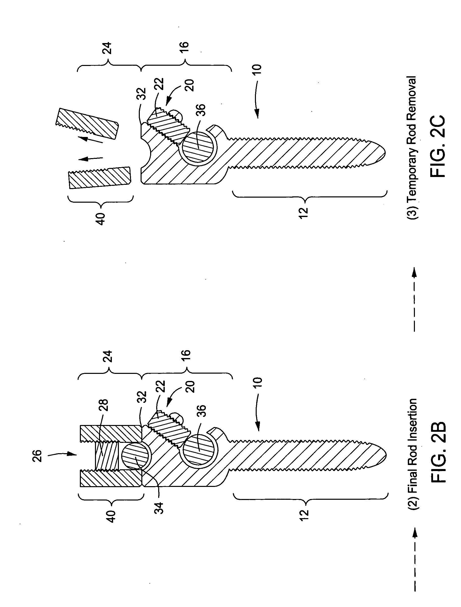 Pedicle Screw