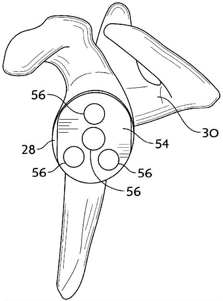 System And Method For Implanting A Secondary Glenoid Prosthesis