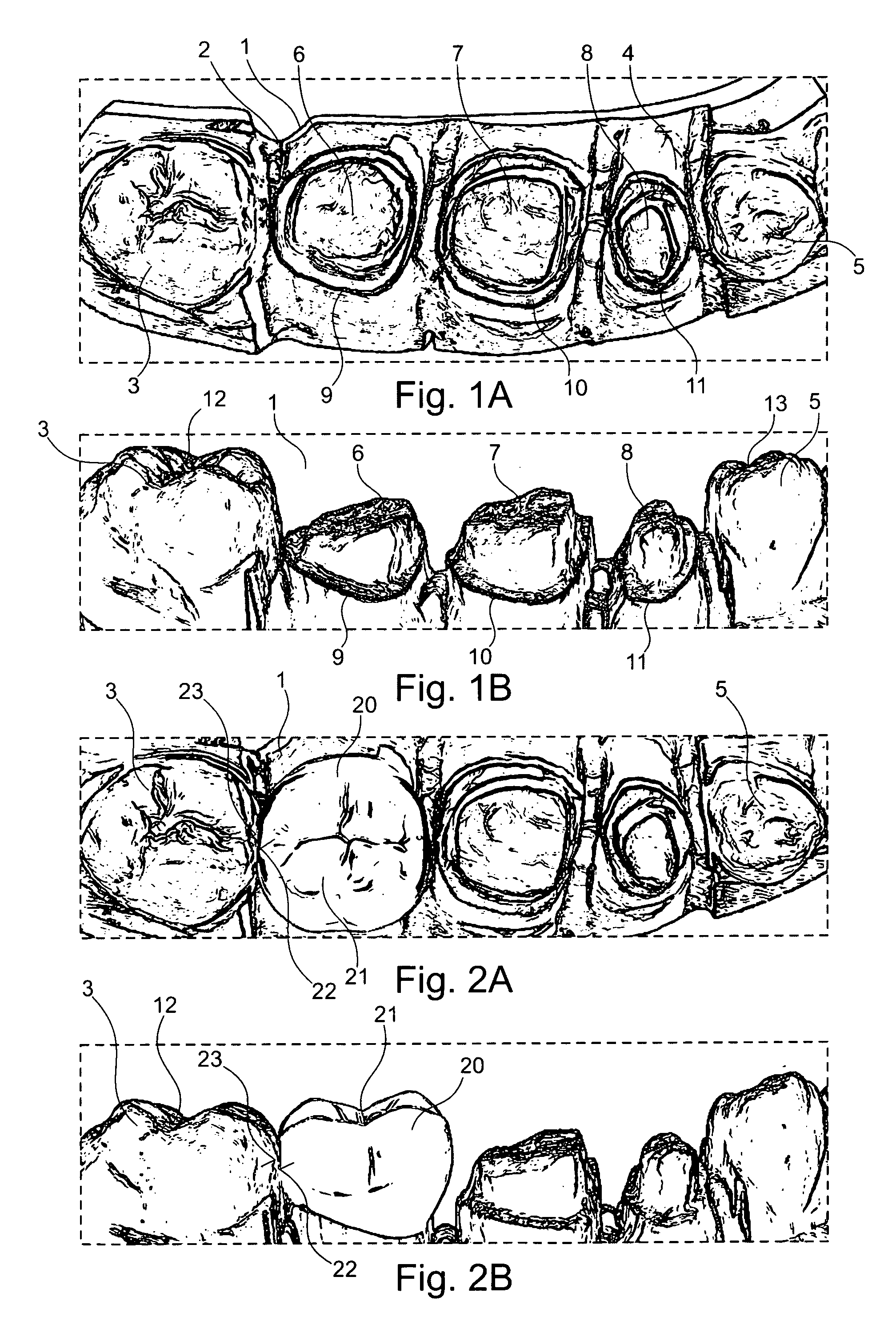 Method for designing a plurality of adjacent tooth restorations using CAD/CAM technology