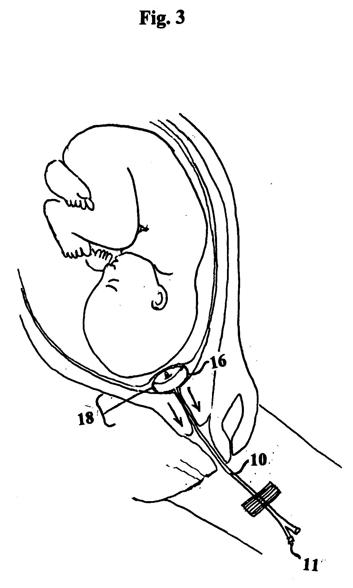 Cervical dilator catheter