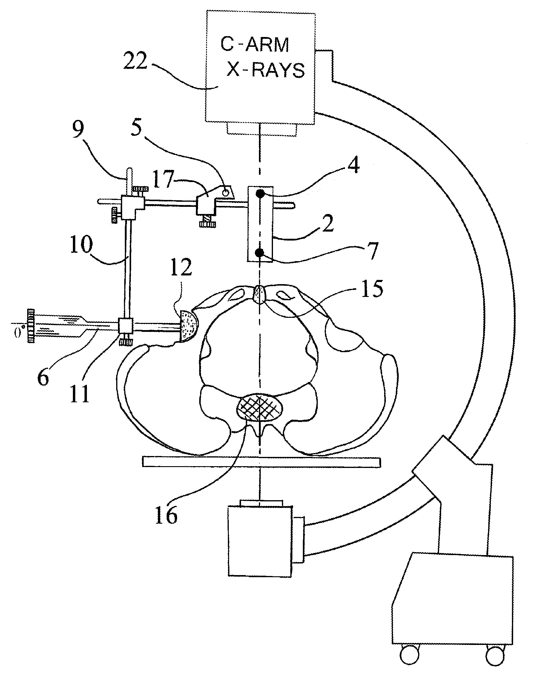 Acetabular cup device and method thereof