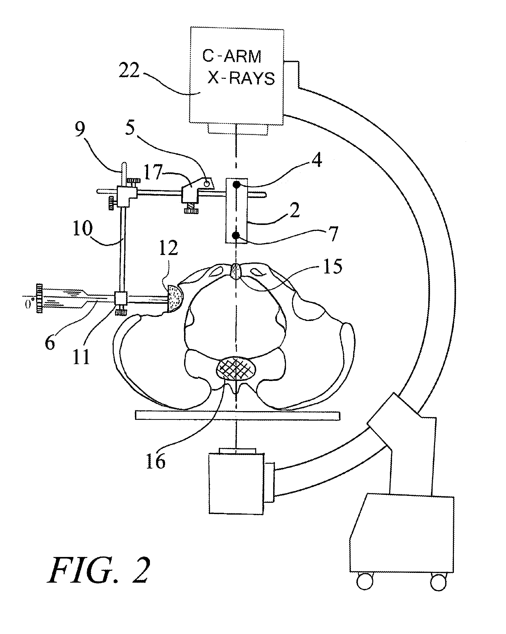 Acetabular cup device and method thereof