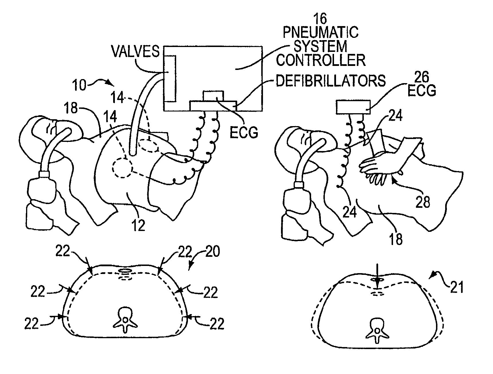 Automated chest compression apparatus
