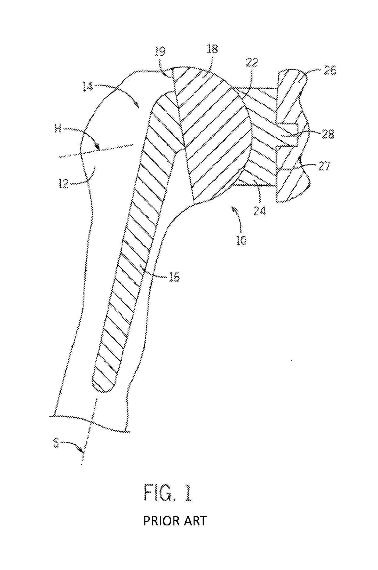 Shoulder prosthesis with variable inclination humeral head component