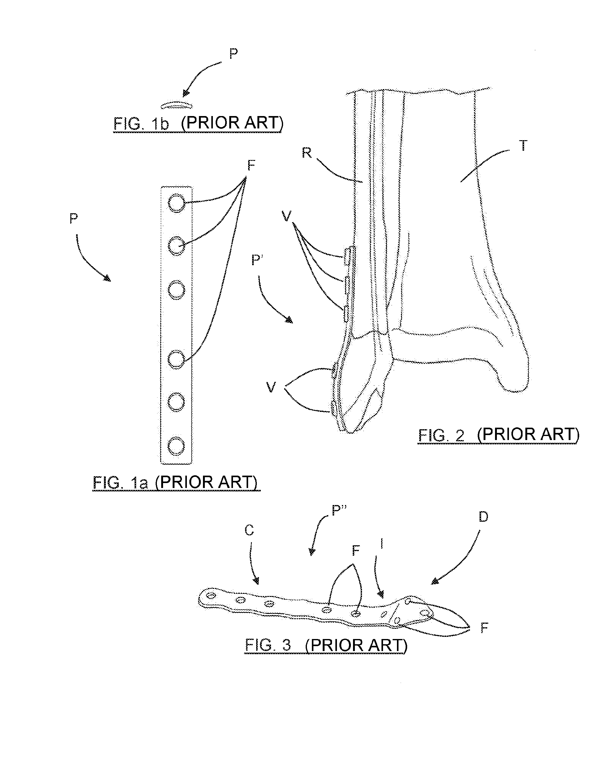 Osteosynthesis plate for distal fibula / lateral malleoulus