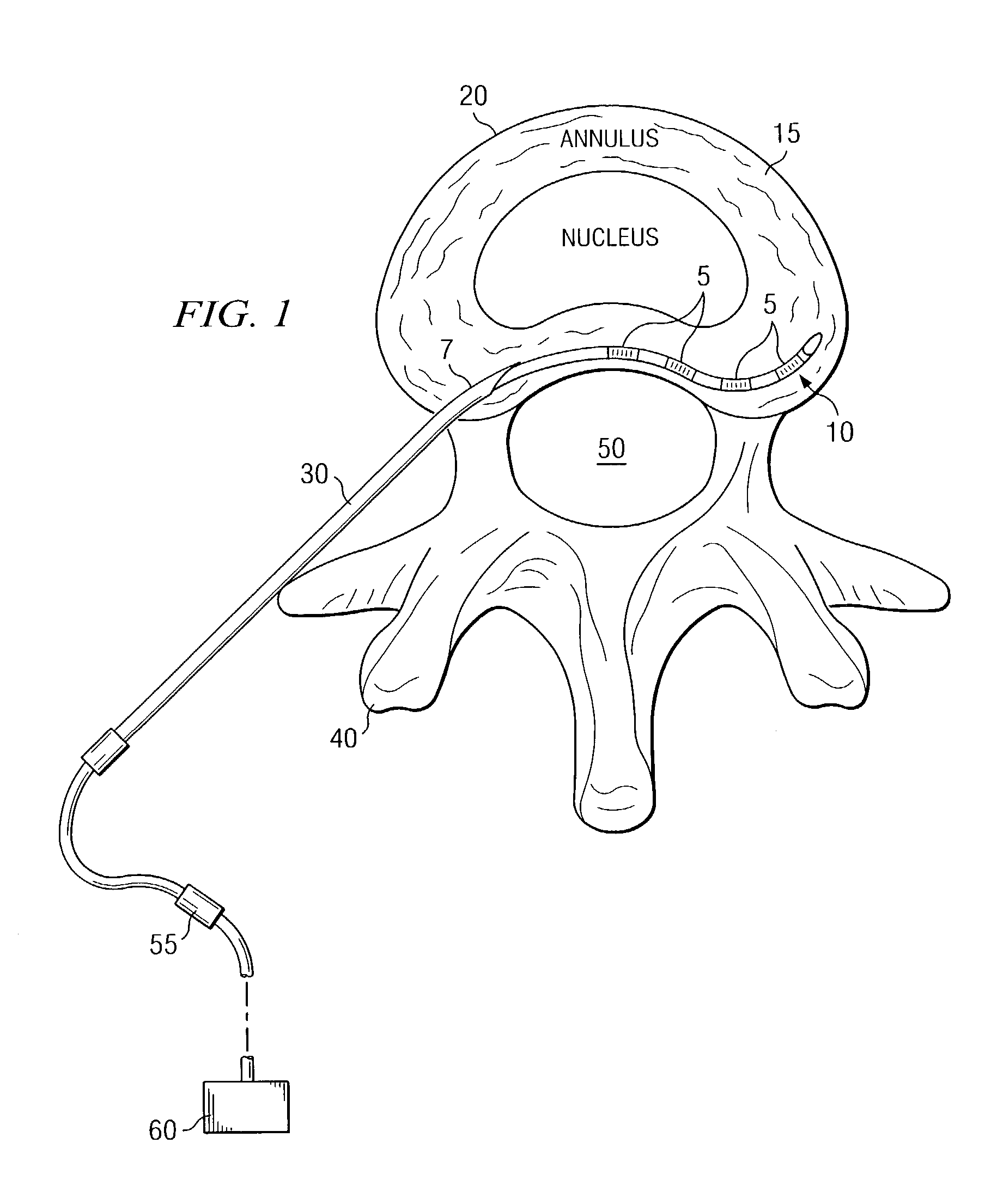 System and method for electrical stimulation of the intervertebral disc