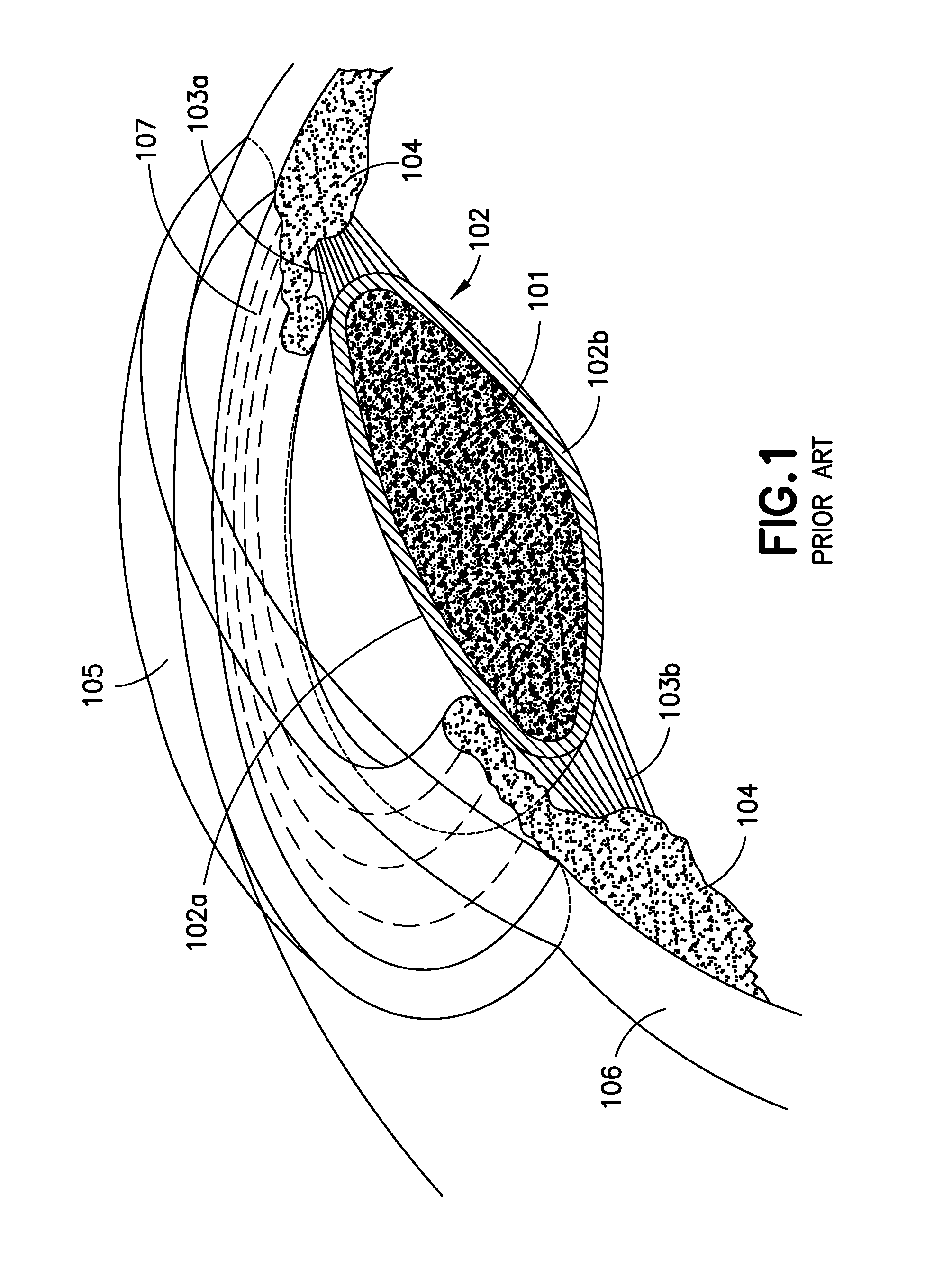 Tensioning rings for anterior capsules and accommodative intraocular lenses for use therewith