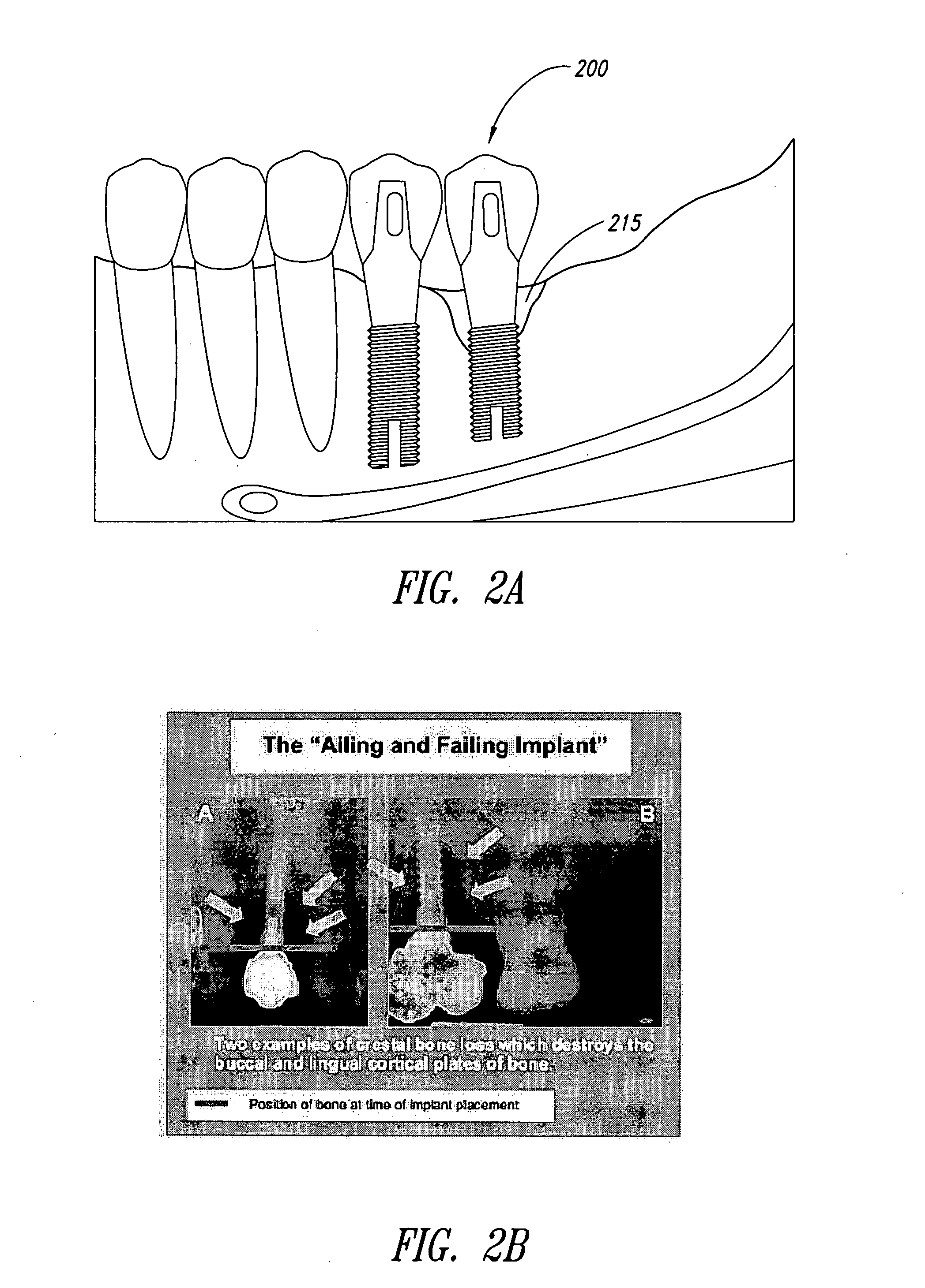 Method and system for repairing endosseous implants, such as with a bone graft implant