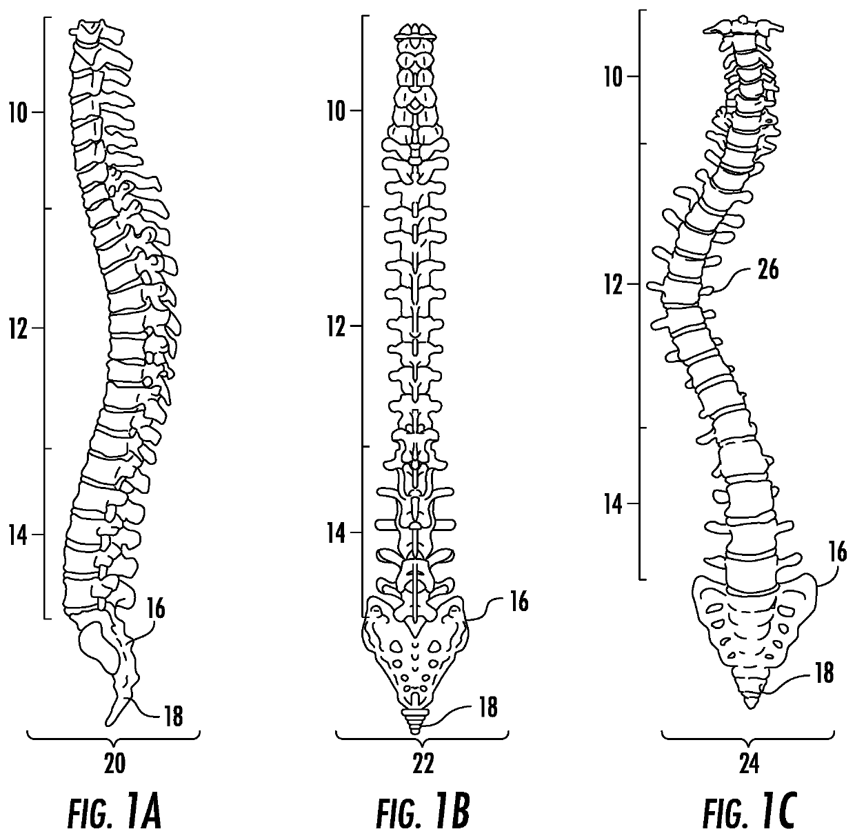 Device and method for correcting spinal deformities in patients