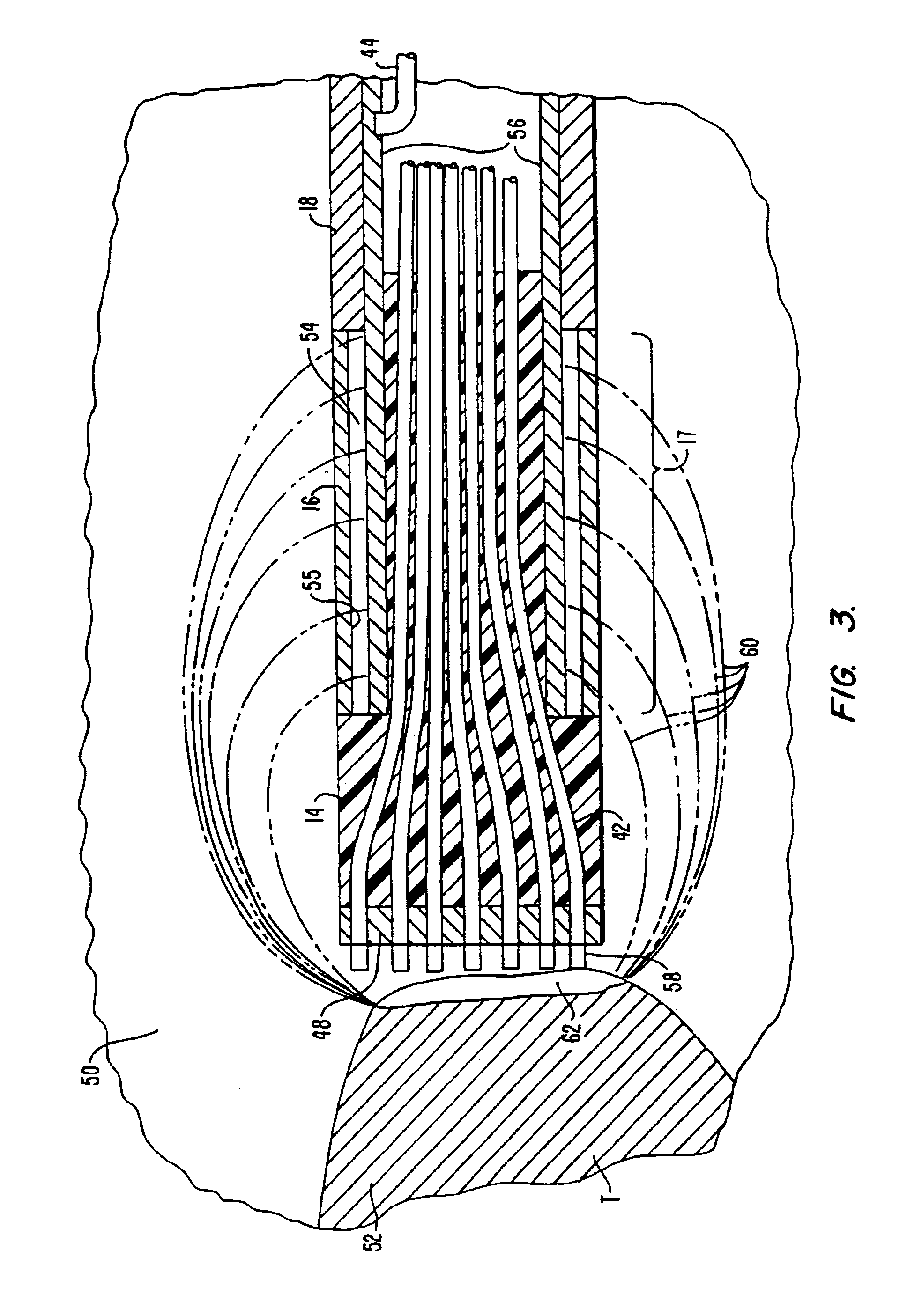 Electrosurgical method using laterally arranged active electrode