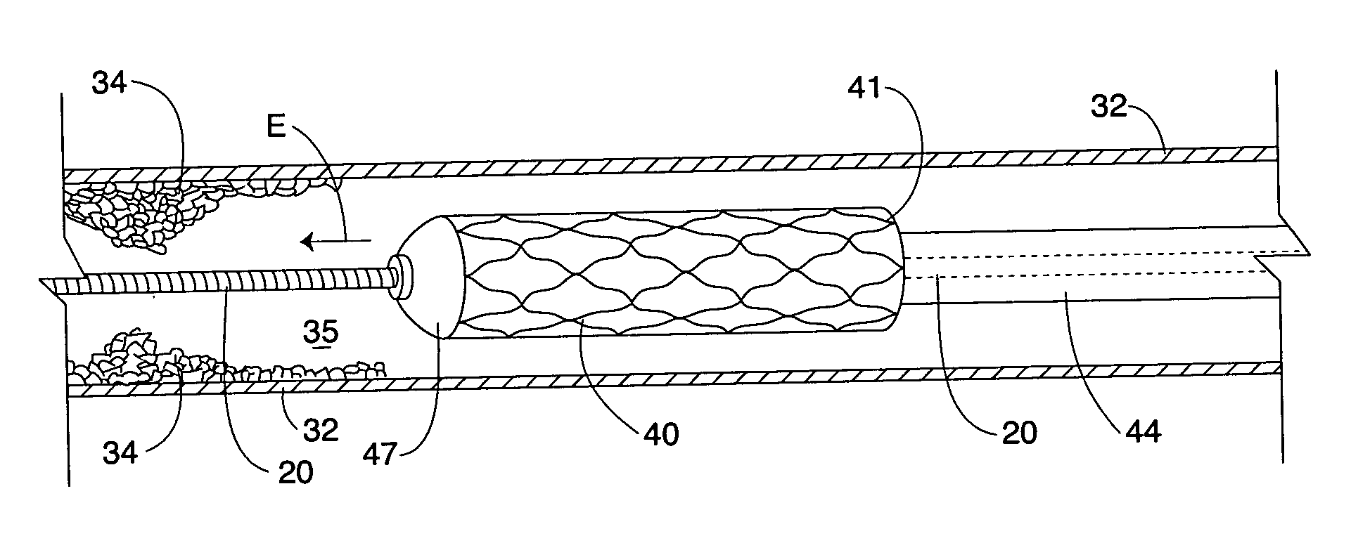 Method for placing a stent through a constricted lumen, and medical device