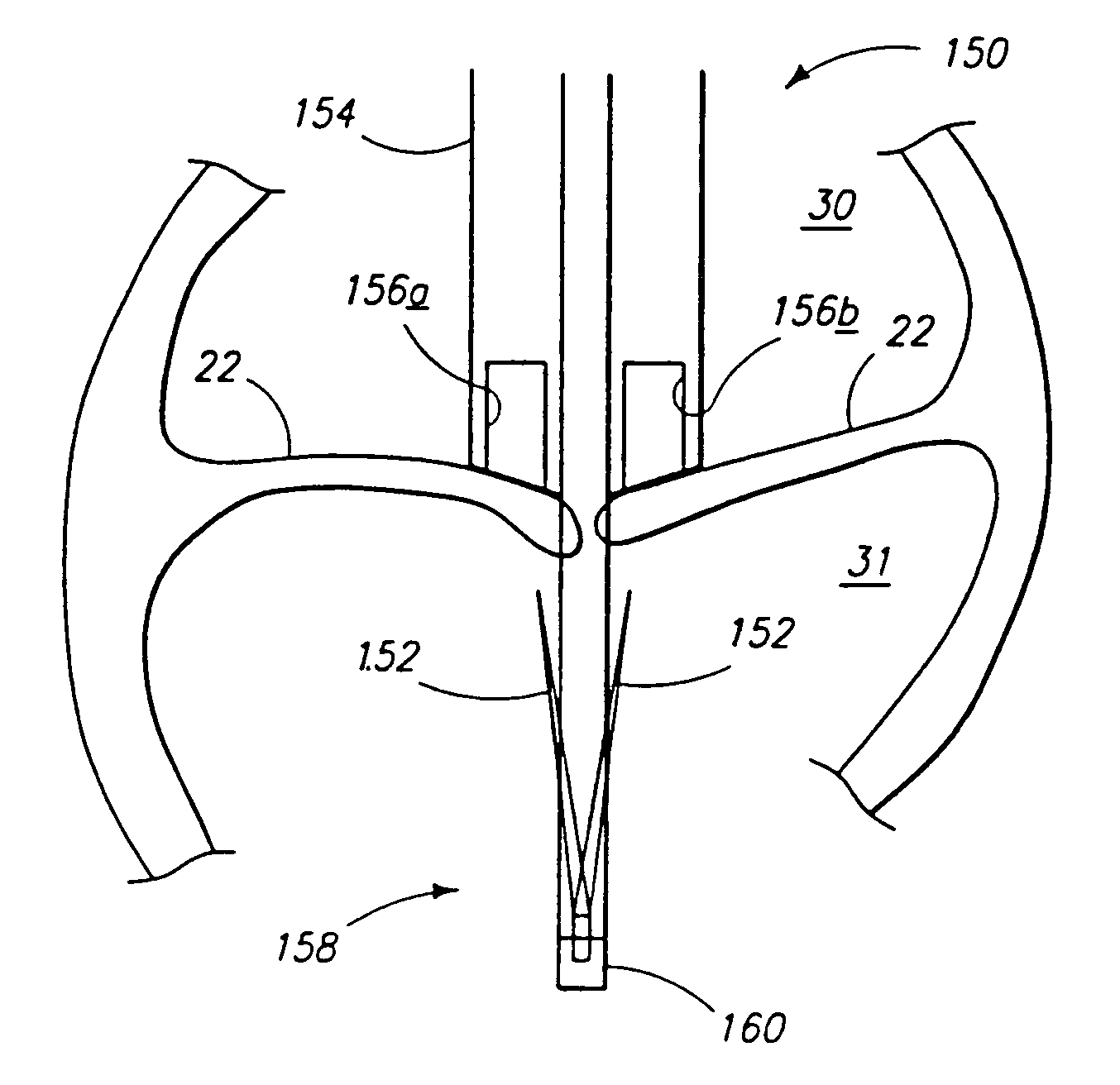 Minimally invasive mitral valve repair method and apparatus