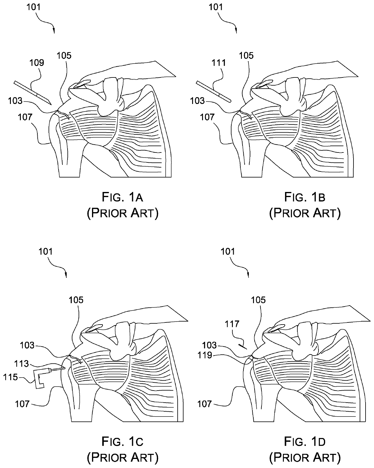 Surgical bone staple device and method of use