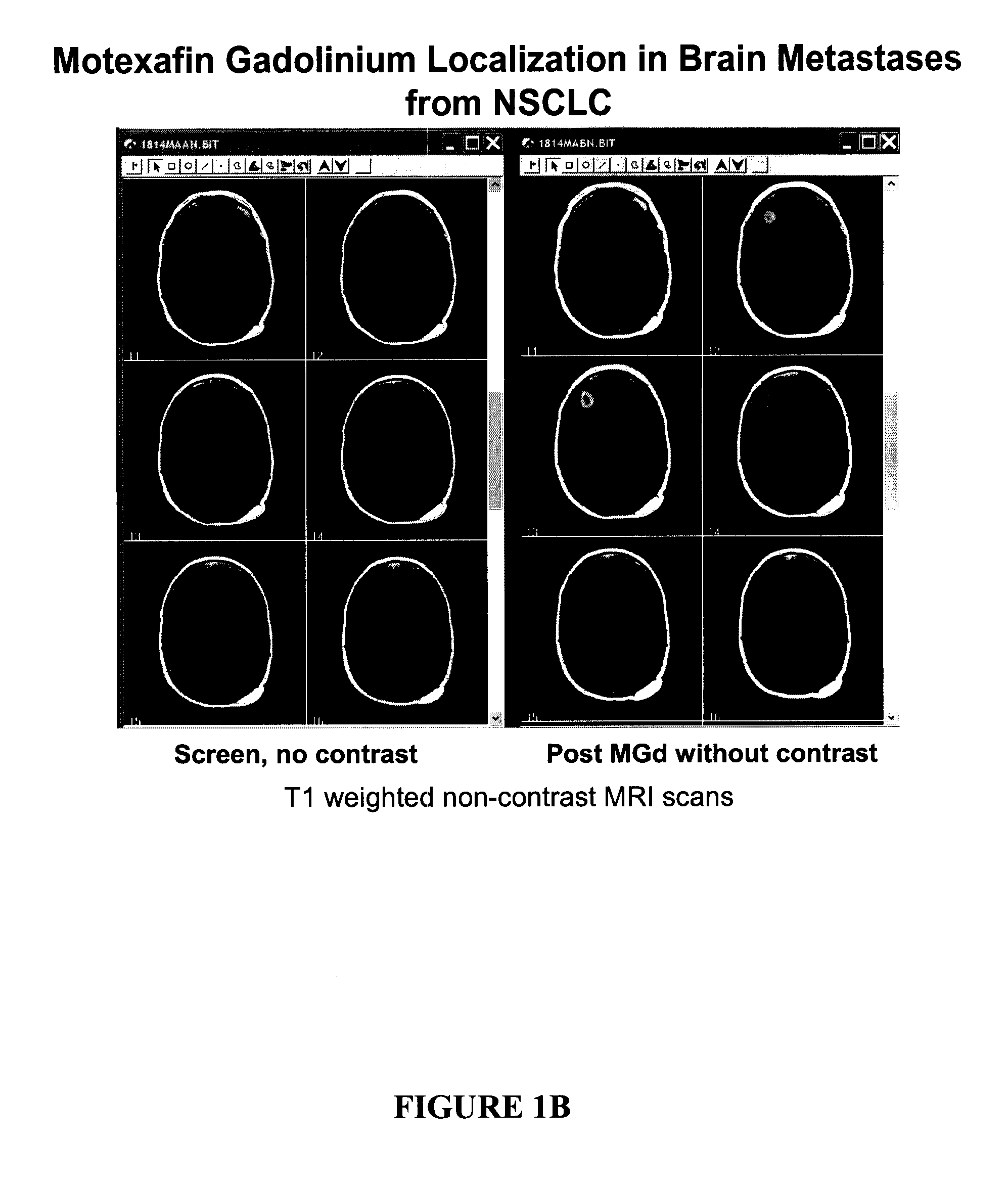 Methods of treating cancer using hypofractionated radiation and texaphyrins