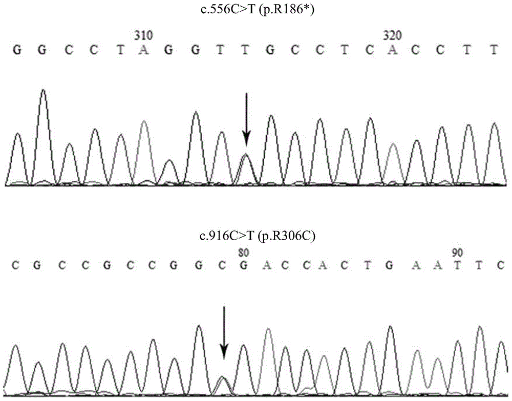 BCS1L gene mutant and use thereof