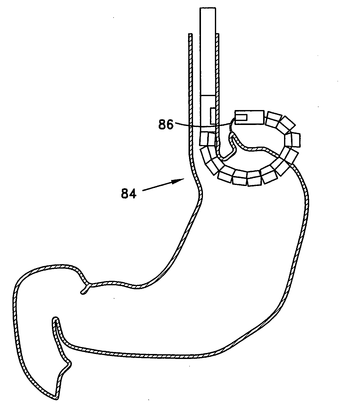 Transgastric method for carrying out a partial fundoplication