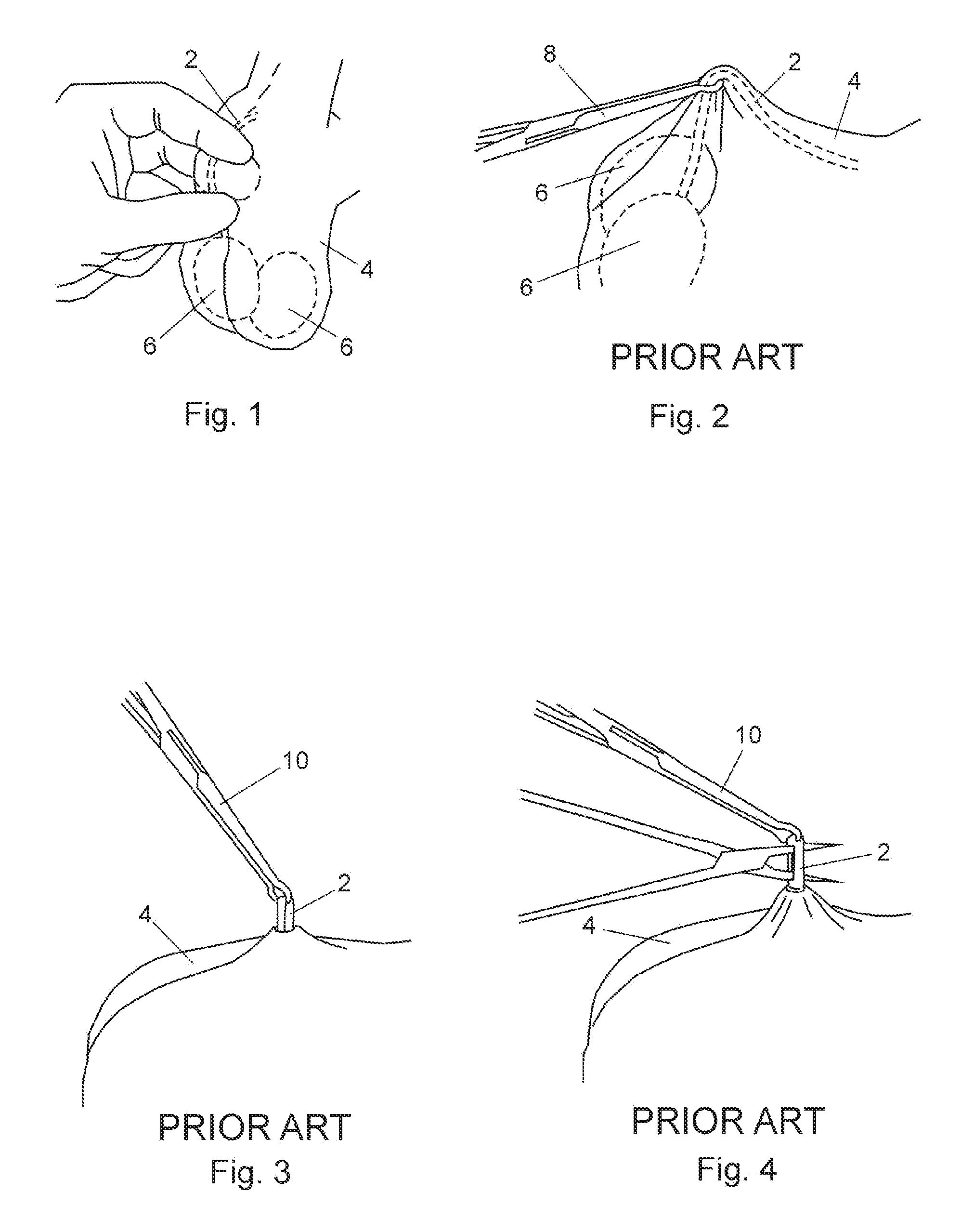 Vasectomy devices and kit and method of use