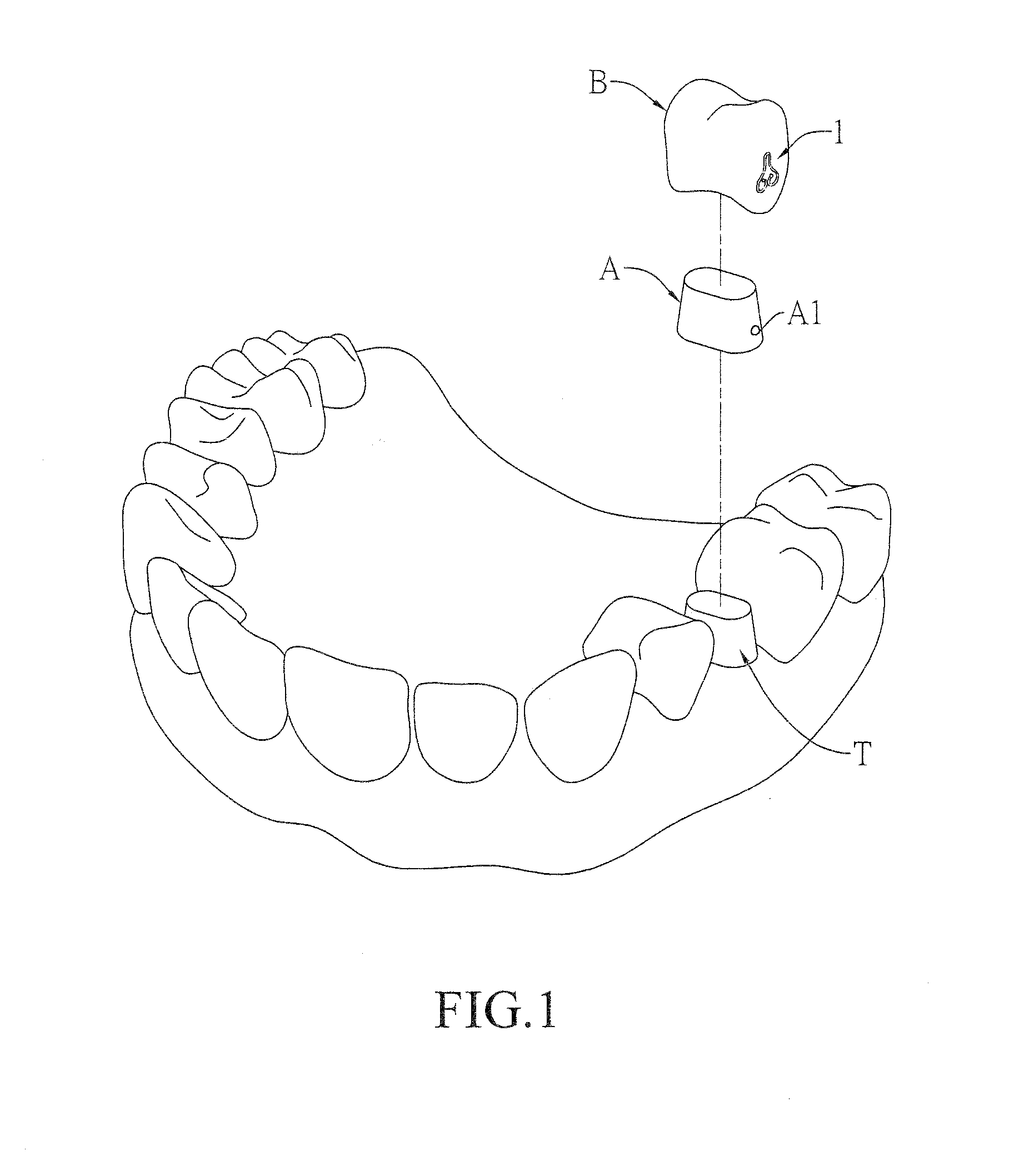 Spring clip mounted to withdrawable artificial tooth and removable artificial tooth assembled with same