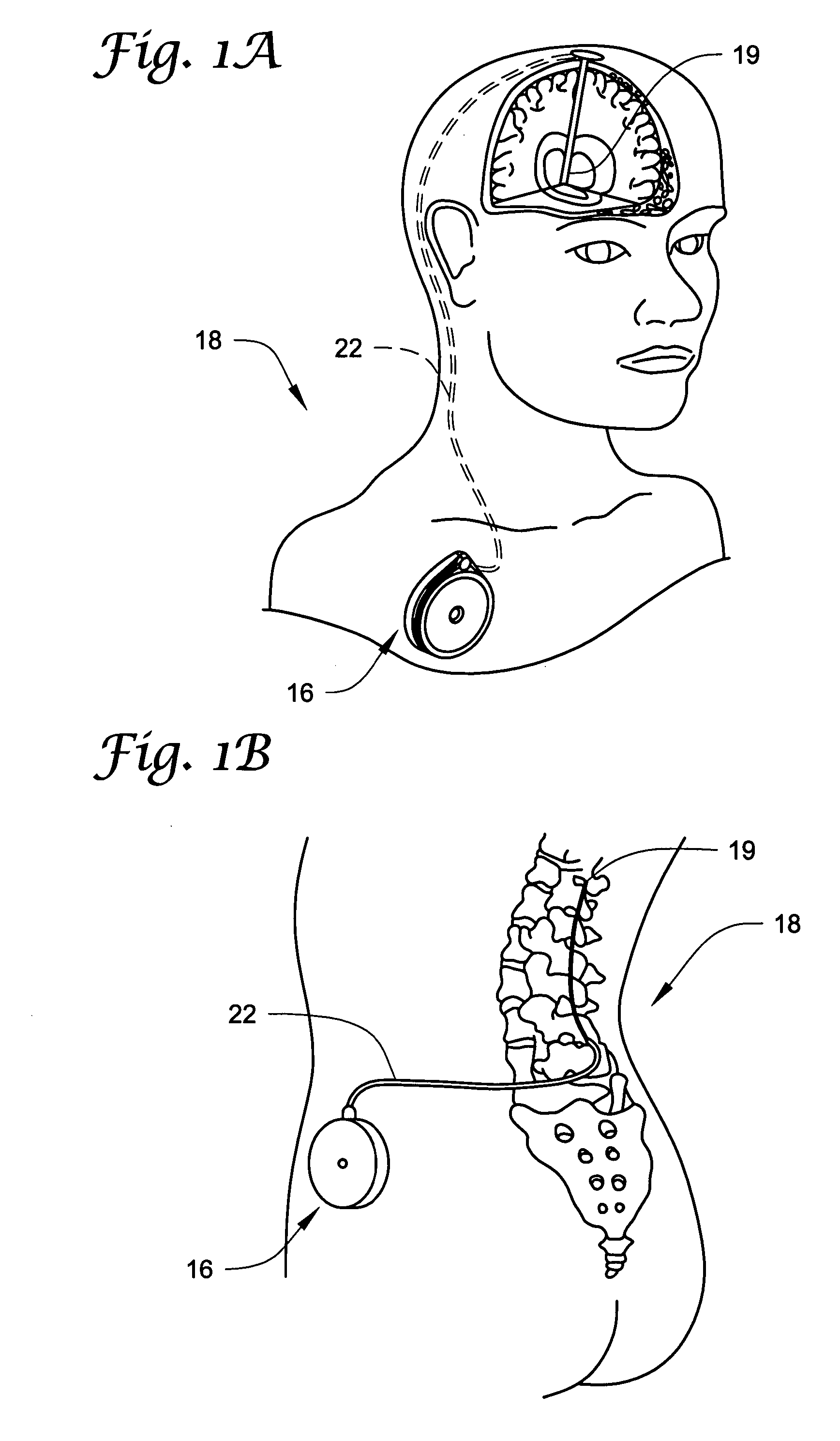 Systems and methods of identifying catheter malfunctions using pressure sensing