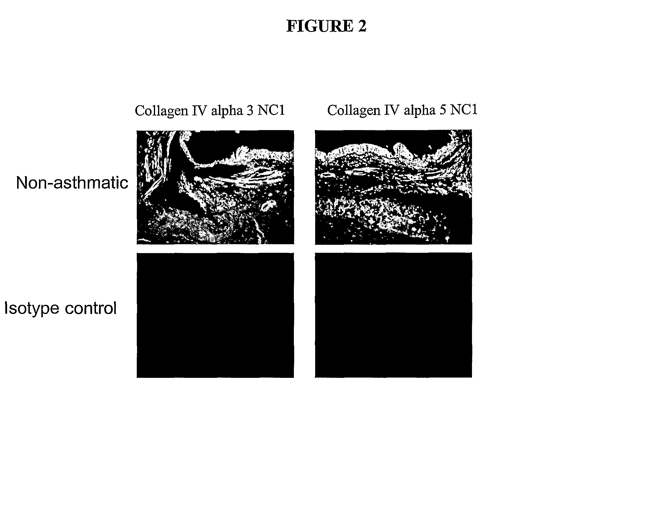 Method of treating conditions associated with airway tissue remodeling