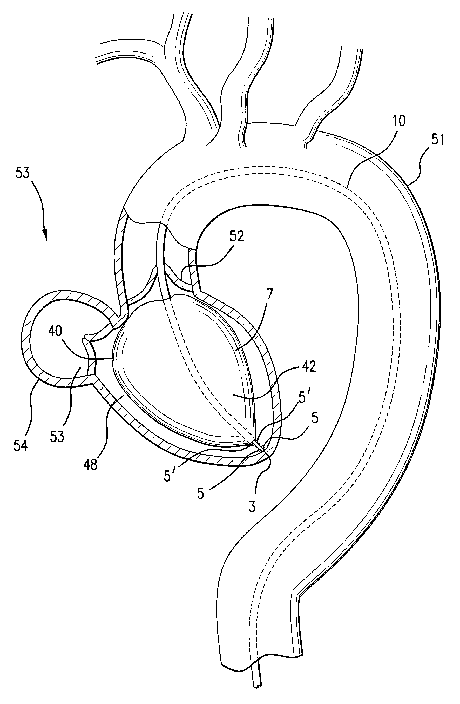 Intra-ventricular cardiac assist device and related method of use