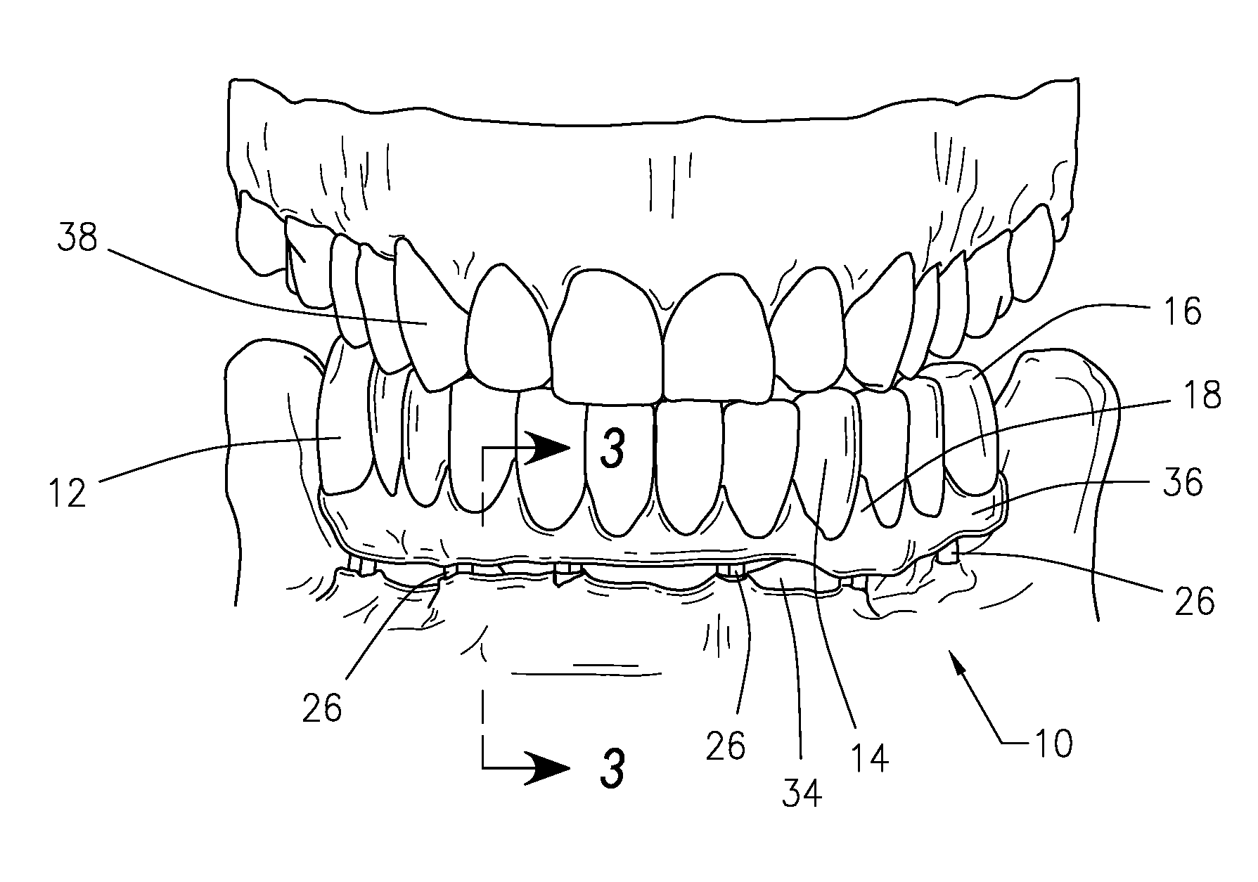 Fixed, Implant-Supported, Full Arch Dental Prosthetics and Methods of Seating Thereof