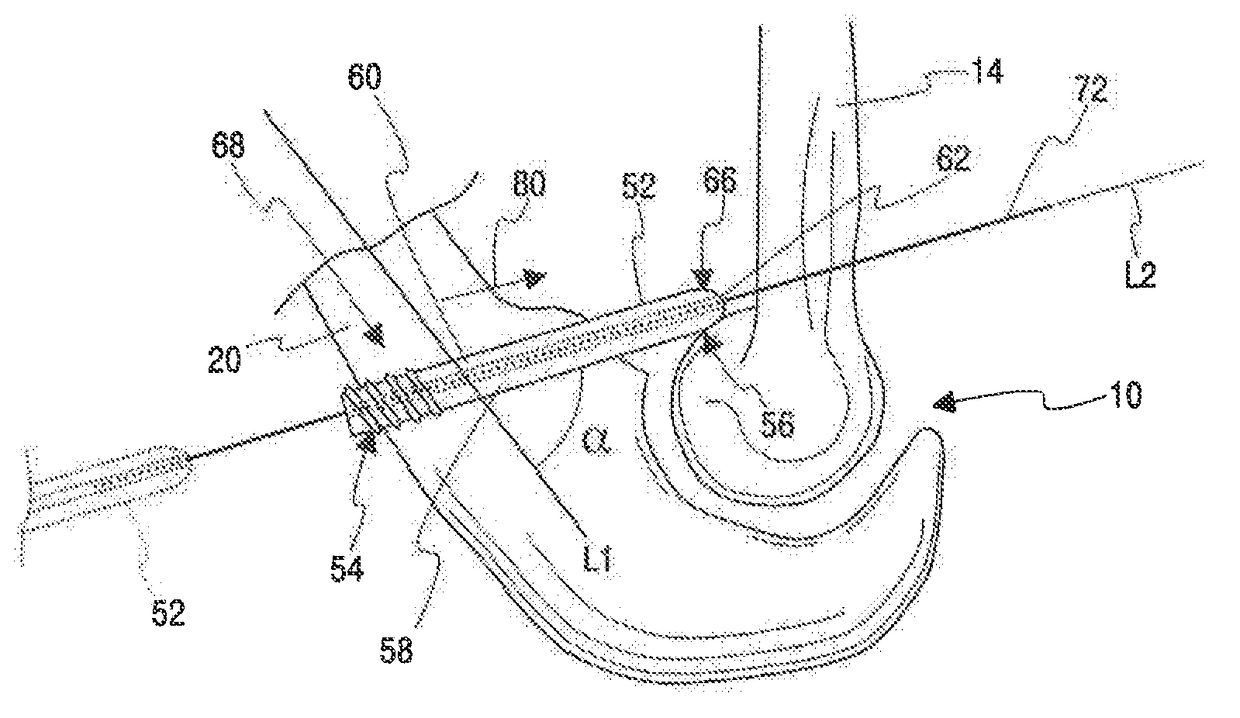 Method of stabilizing a patient's ulnohumeral joint