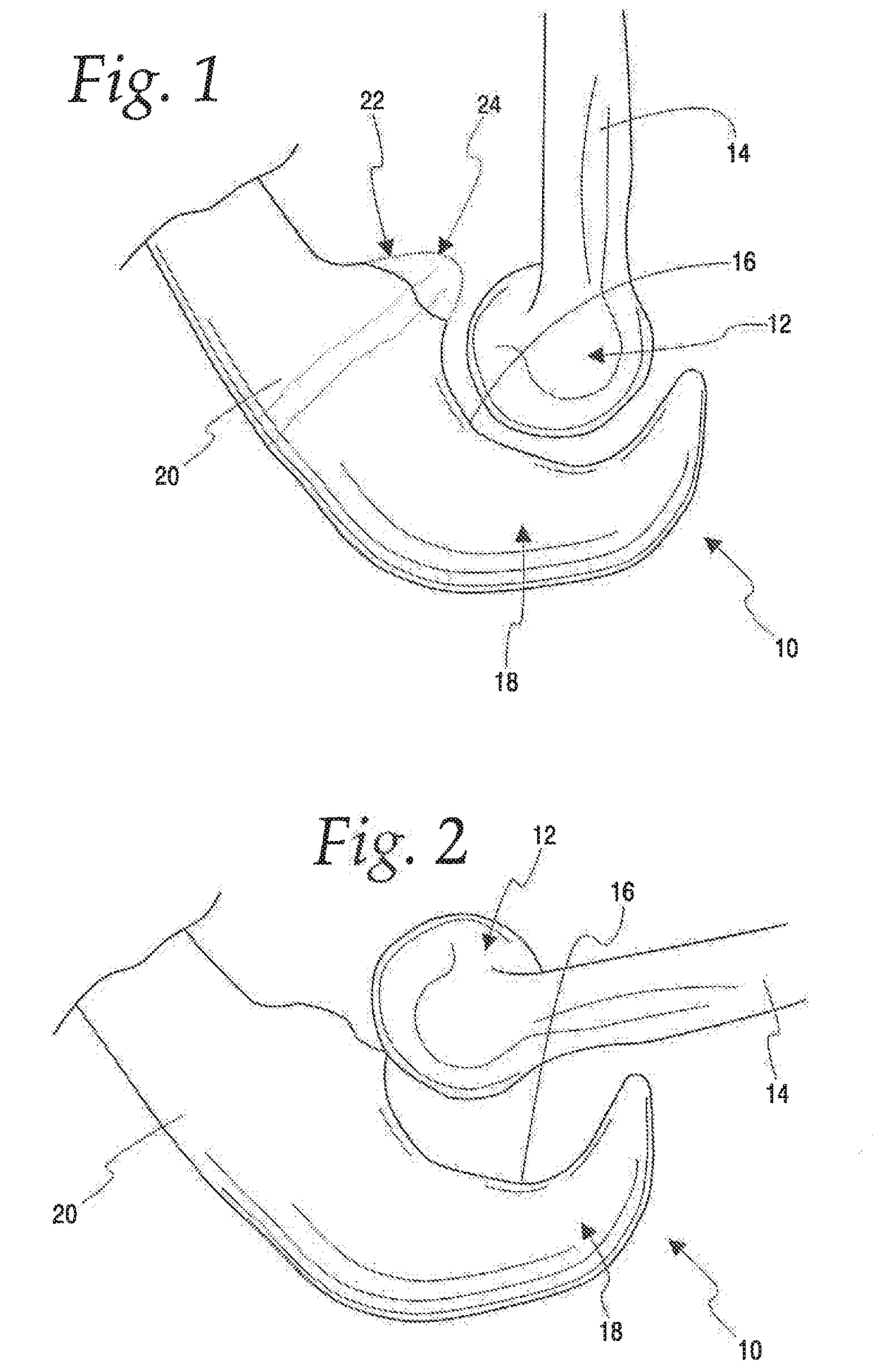 Method of stabilizing a patient's ulnohumeral joint