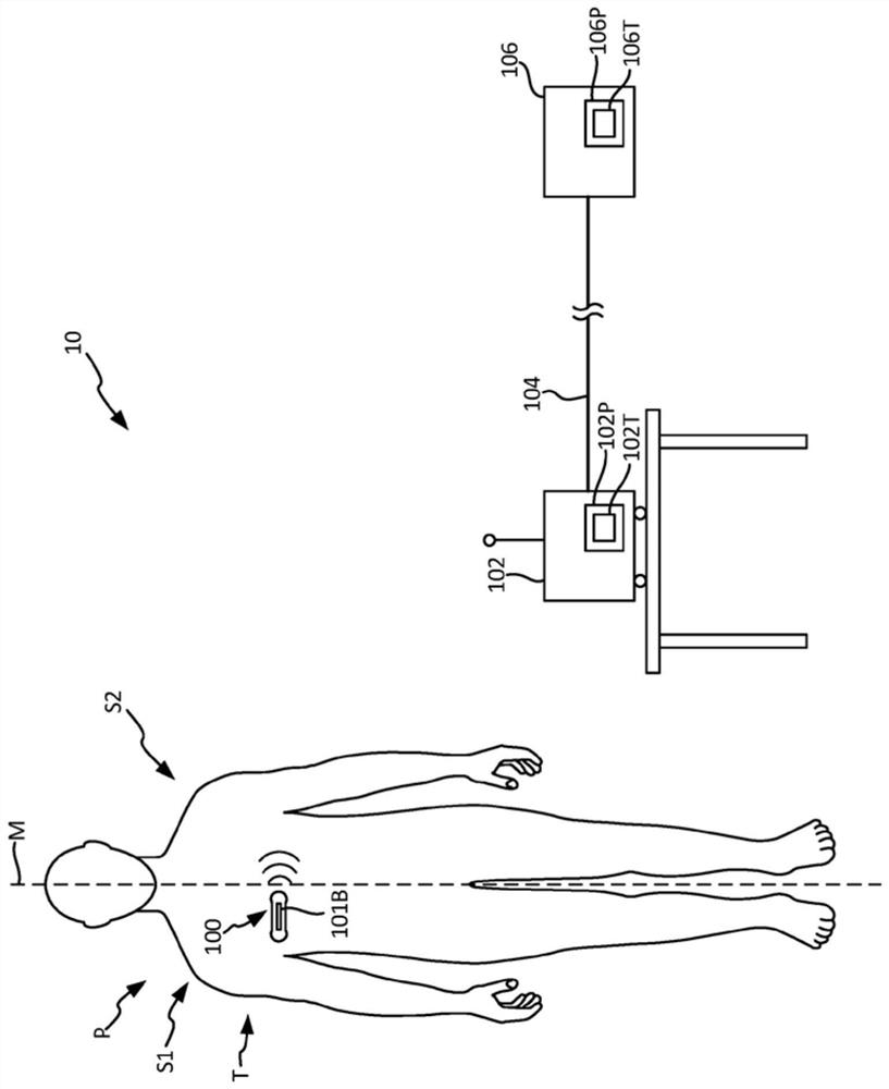 Systems and methods for determining premature ventricular contraction (pvc) type and load