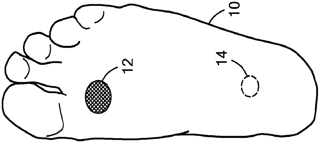 Footwear system for ulcer or pre-ulcer detection