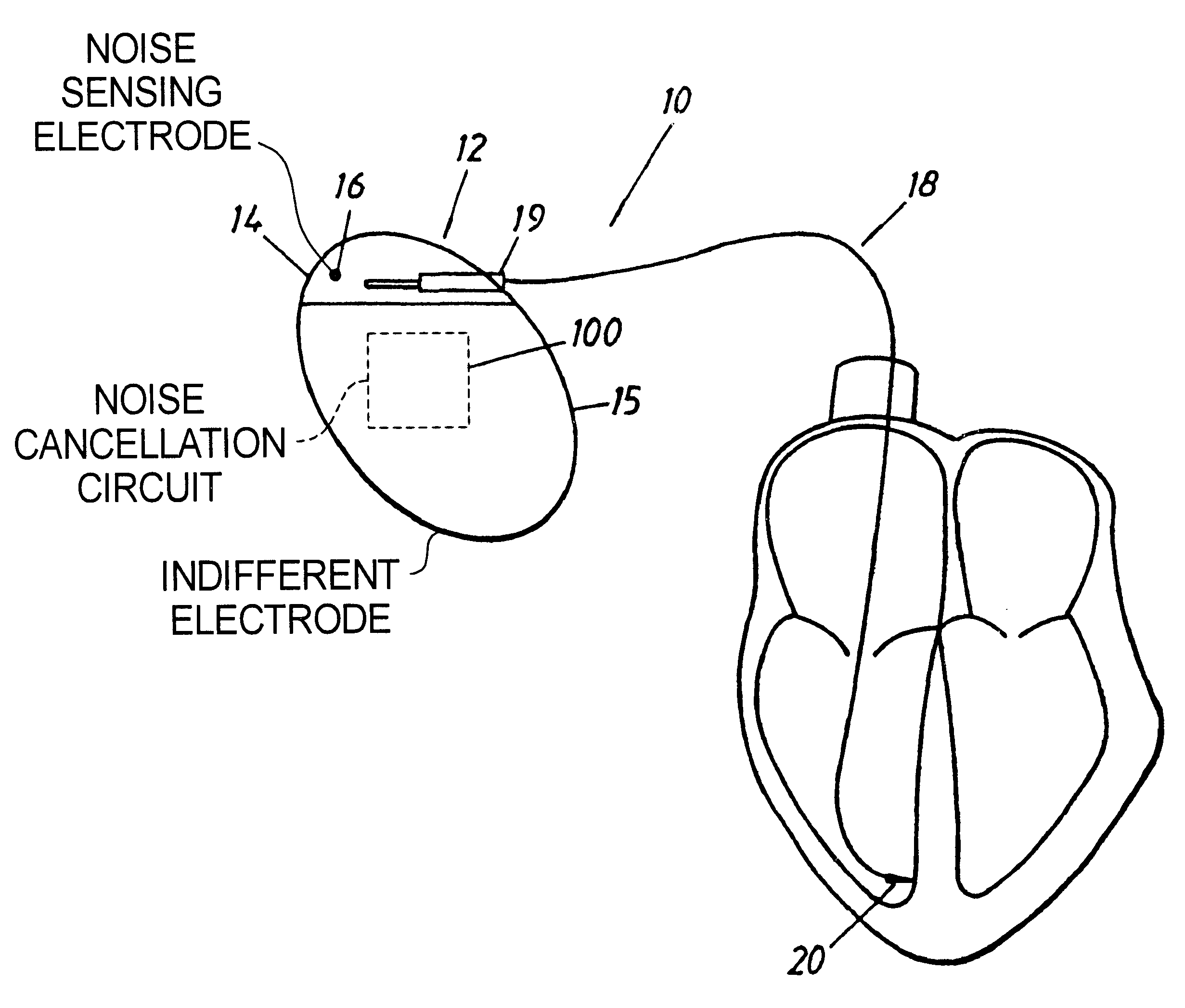 Implantable cardiac stimulator with circuitry for removing noise in sensed electrical signals