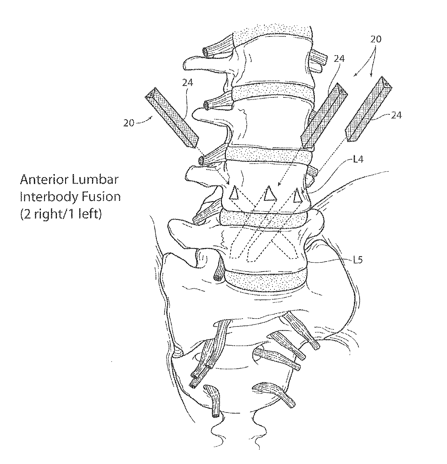 Apparatus, systems, and methods for stabilizing a spondylolisthesis