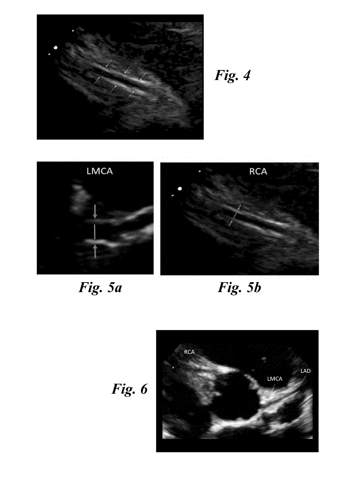 Ultrasound automated method for measuring the thickness of the walls of the left anterior descending, right and circumflex coronary arteries