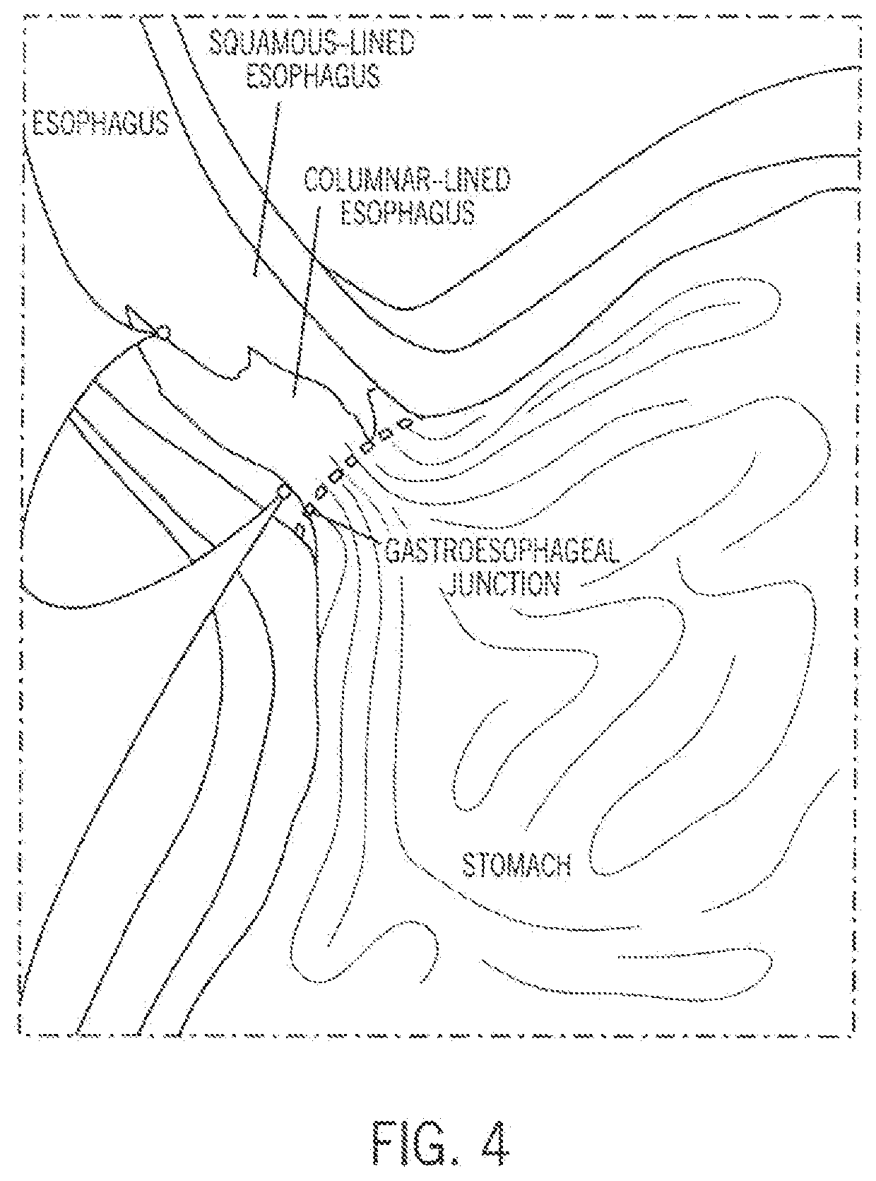 Esophageal ablation technology