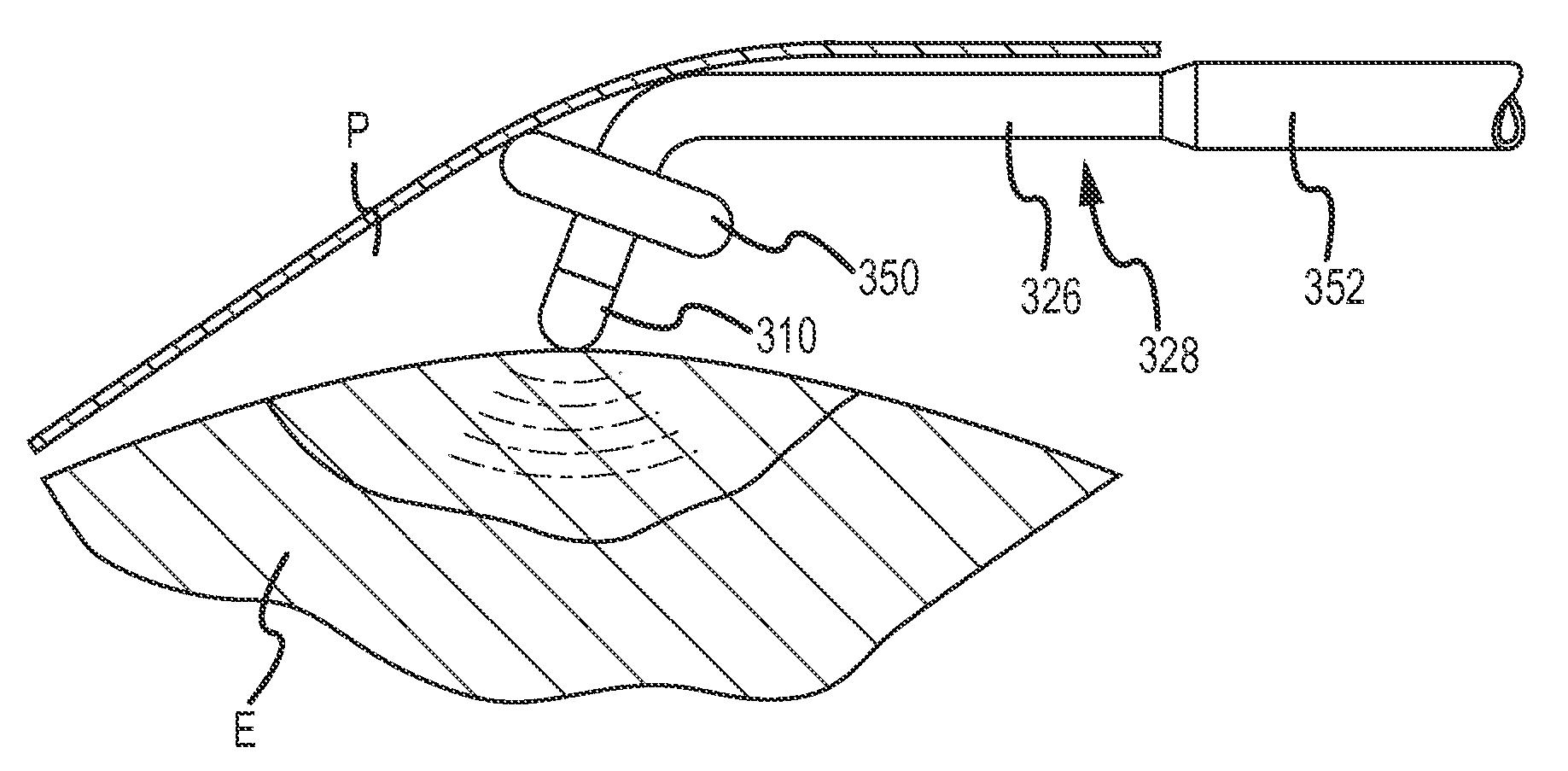 Ablation electrode and catheter assembly for epicardial mapping and ablation with directionally focused RF energy