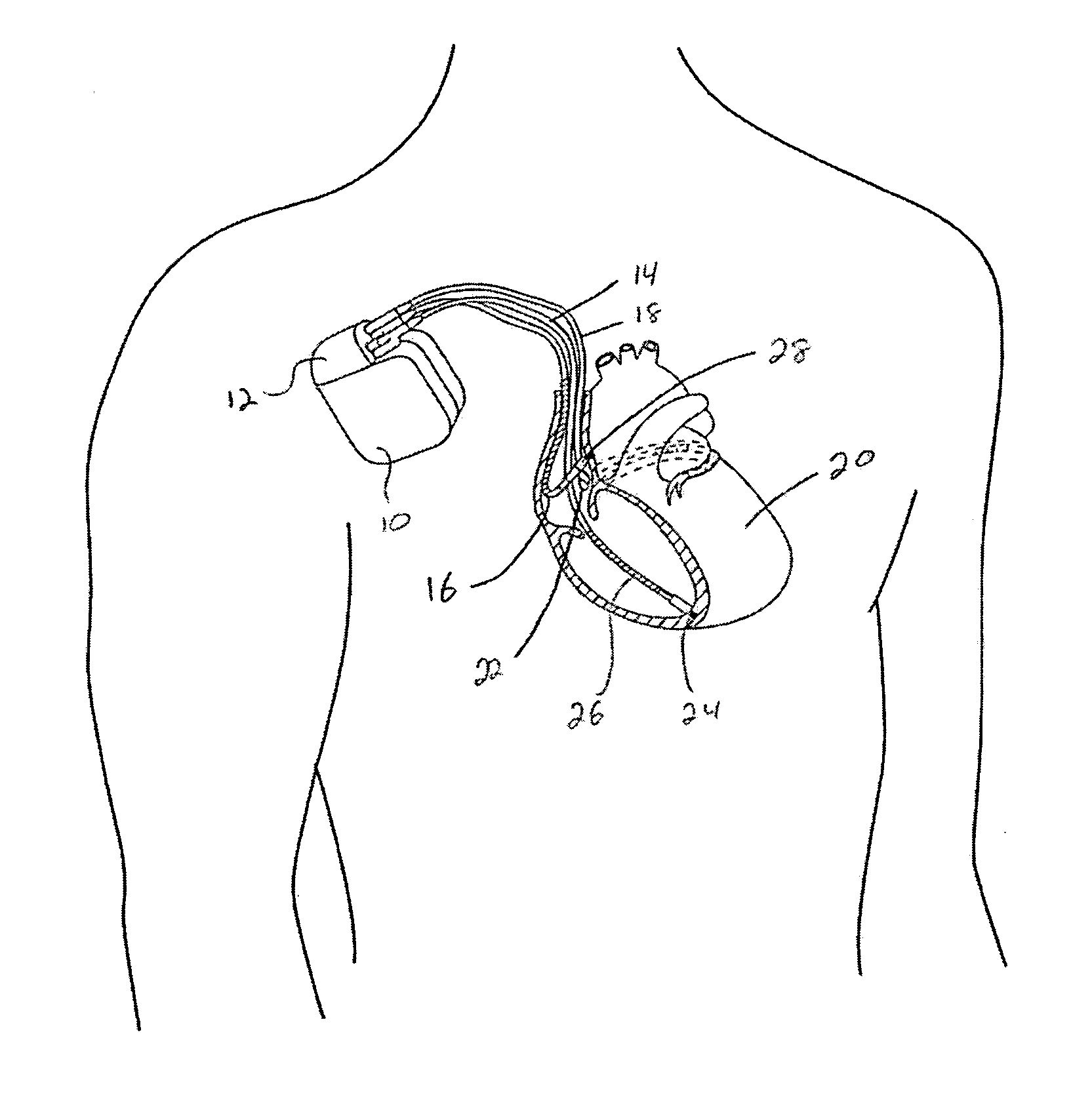Trans-septal anchoring system and method