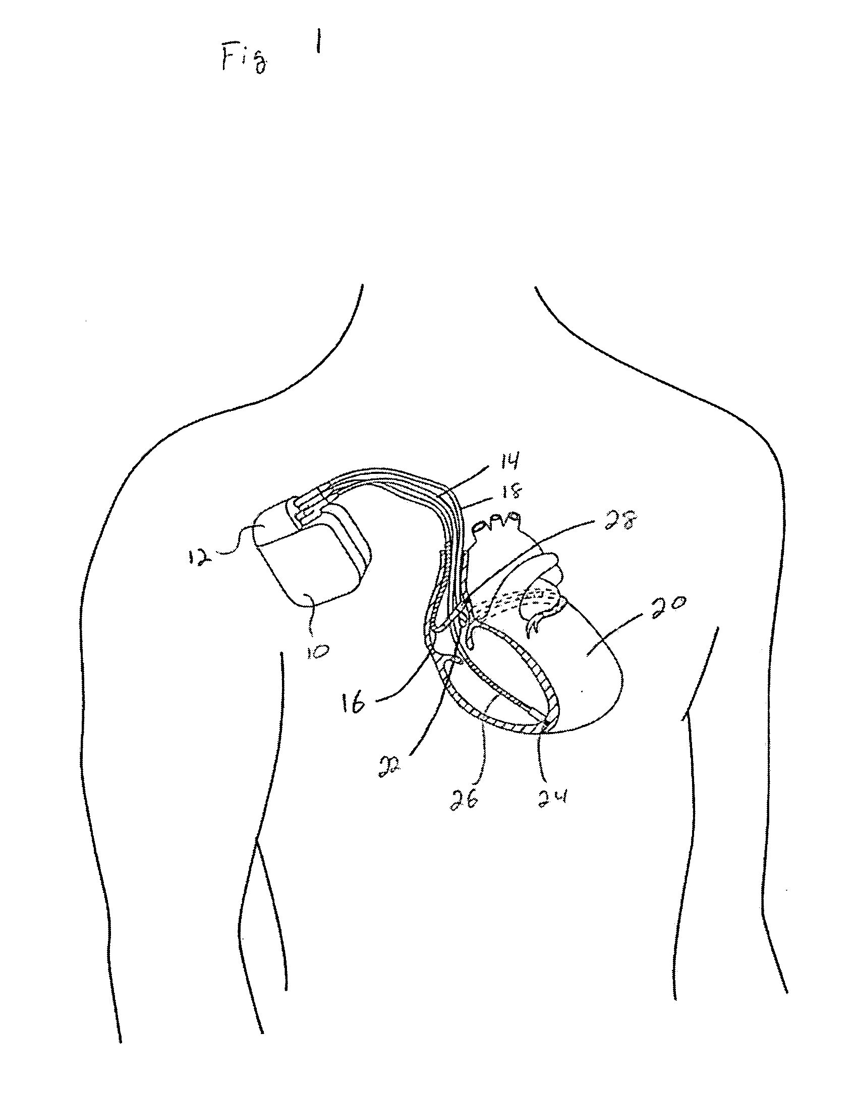 Trans-septal anchoring system and method