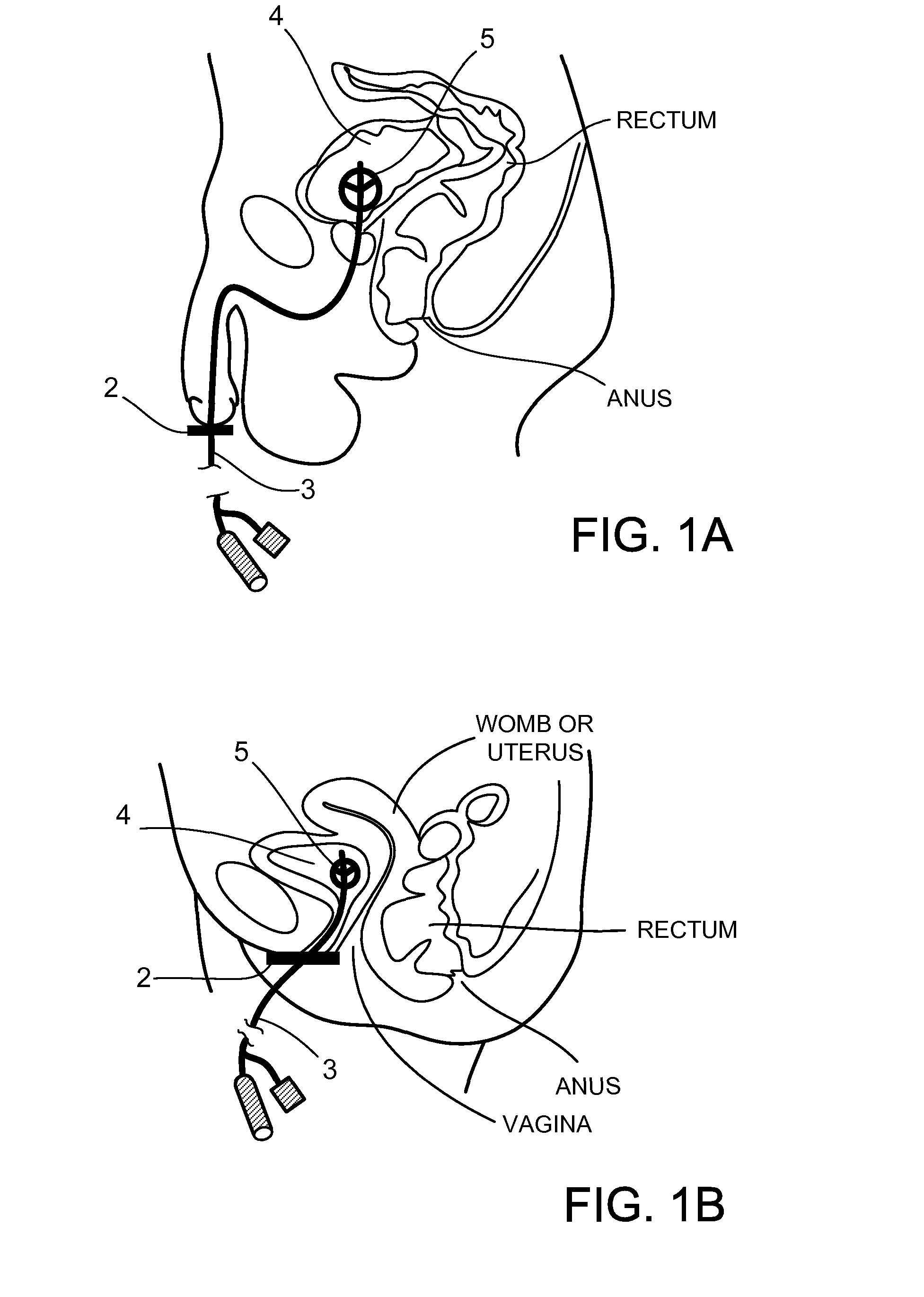 Urethral catheter tension holding and movement stabilizing devices