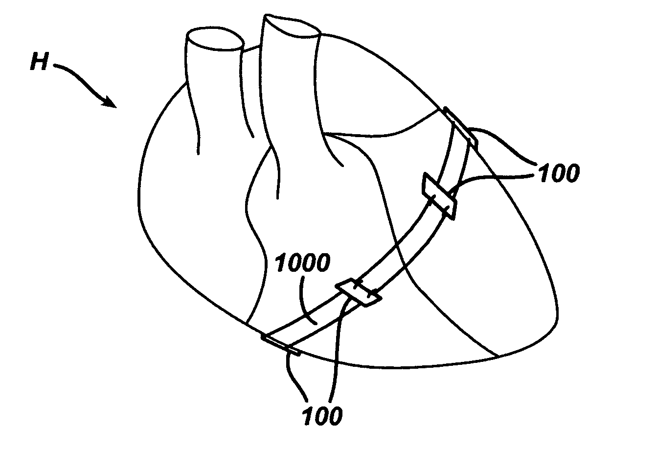 Systems and methods for assisting cardiac valve coaptation