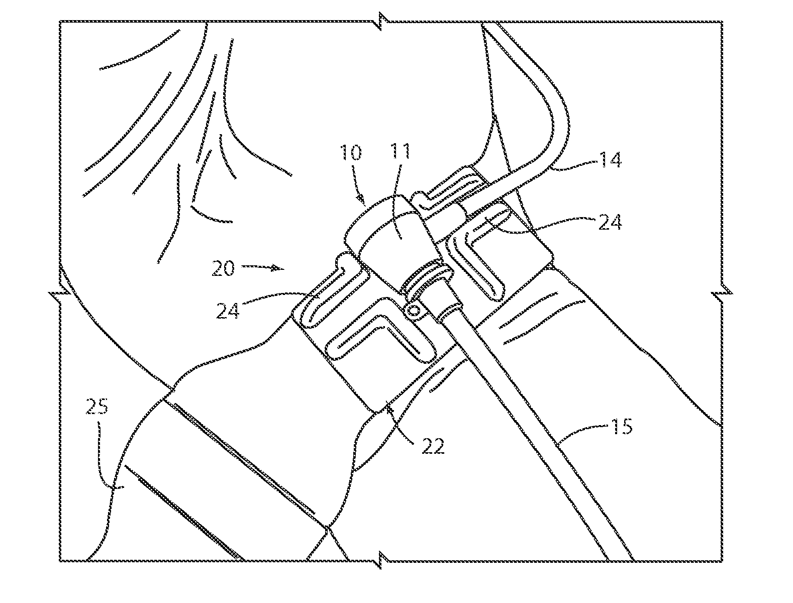Method and device for interventional site management of sheaths and catheters