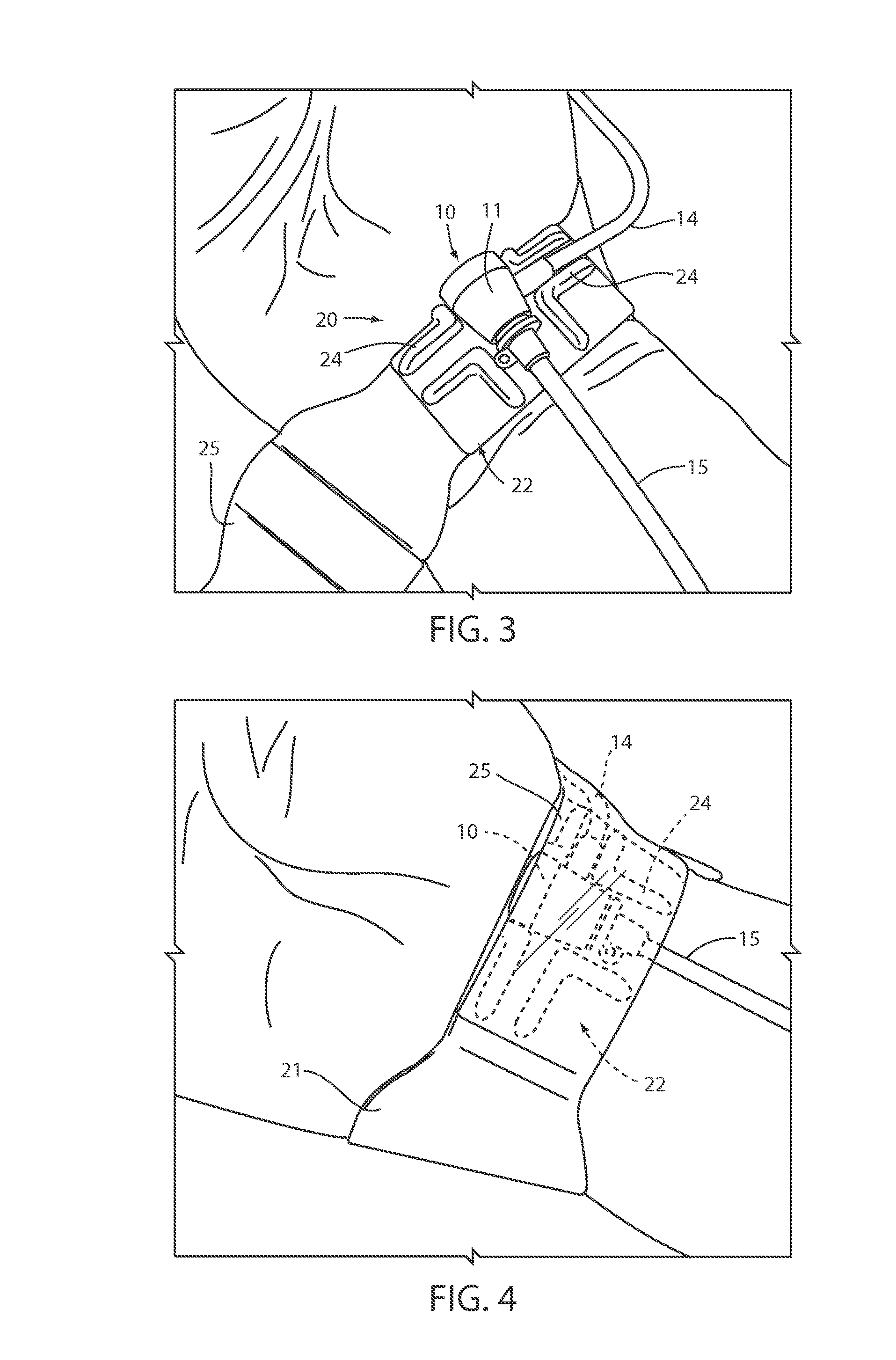 Method and device for interventional site management of sheaths and catheters