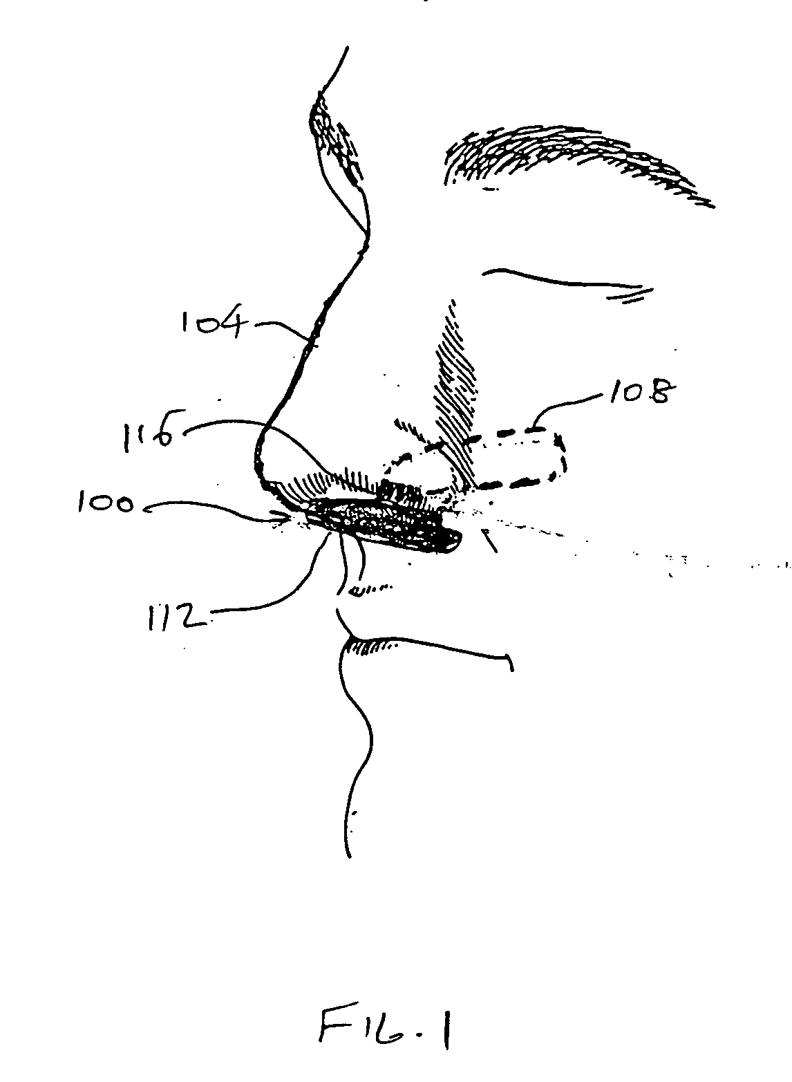 Nose pack method and apparatus