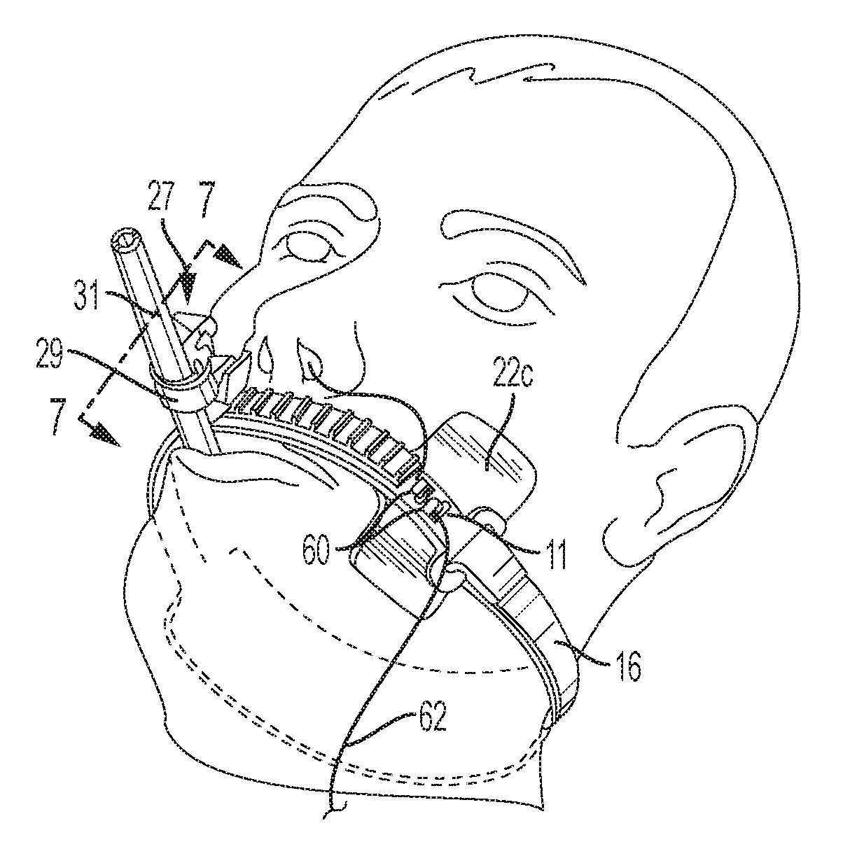 Endotracheal Tube and Nasogastric Tube Attachment Device