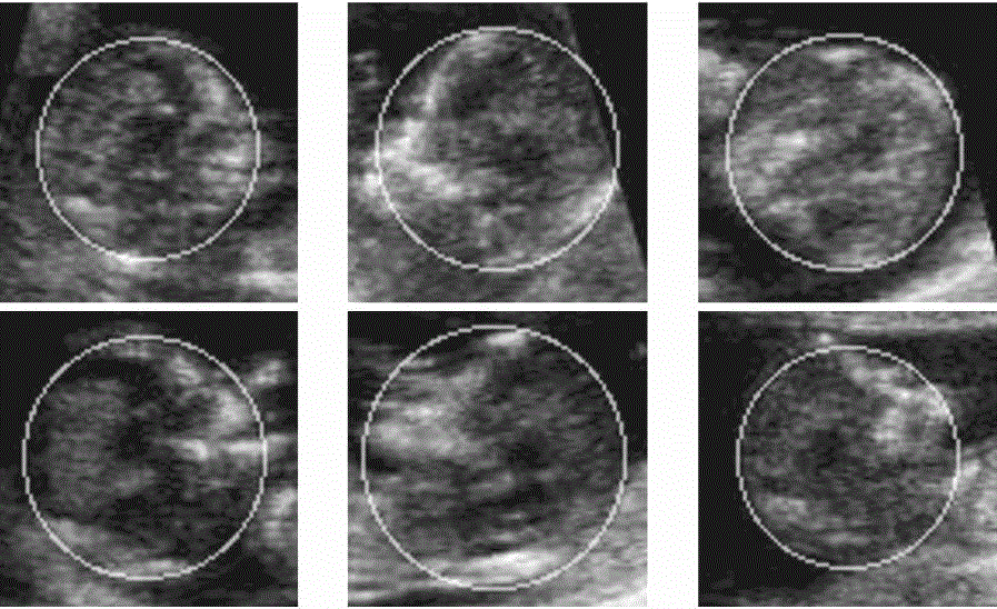 Automatic fetus median sagittal plane detection method based on depth belief network and three dimensional model