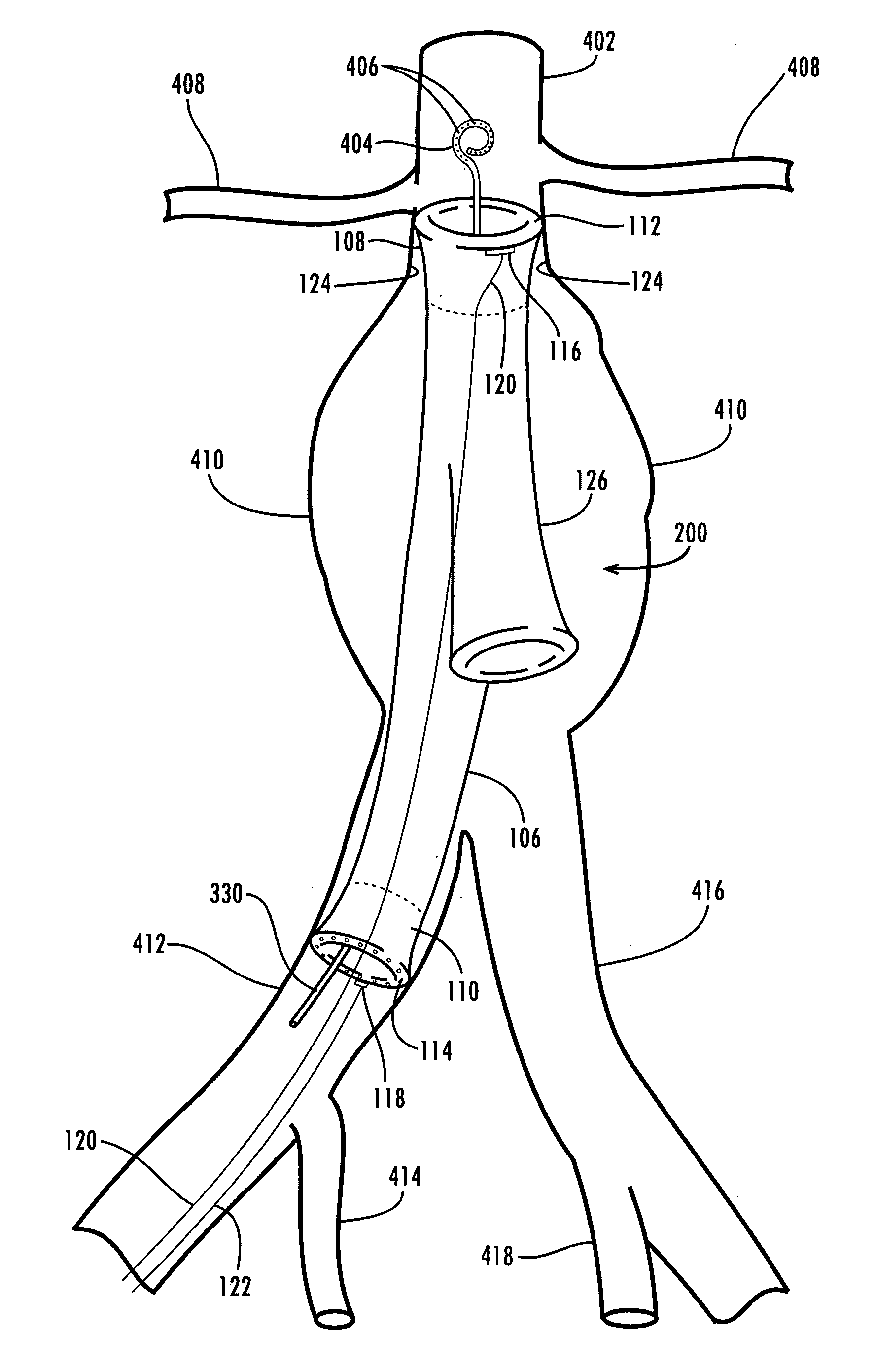 Sealable endovascular implants and methods for their use