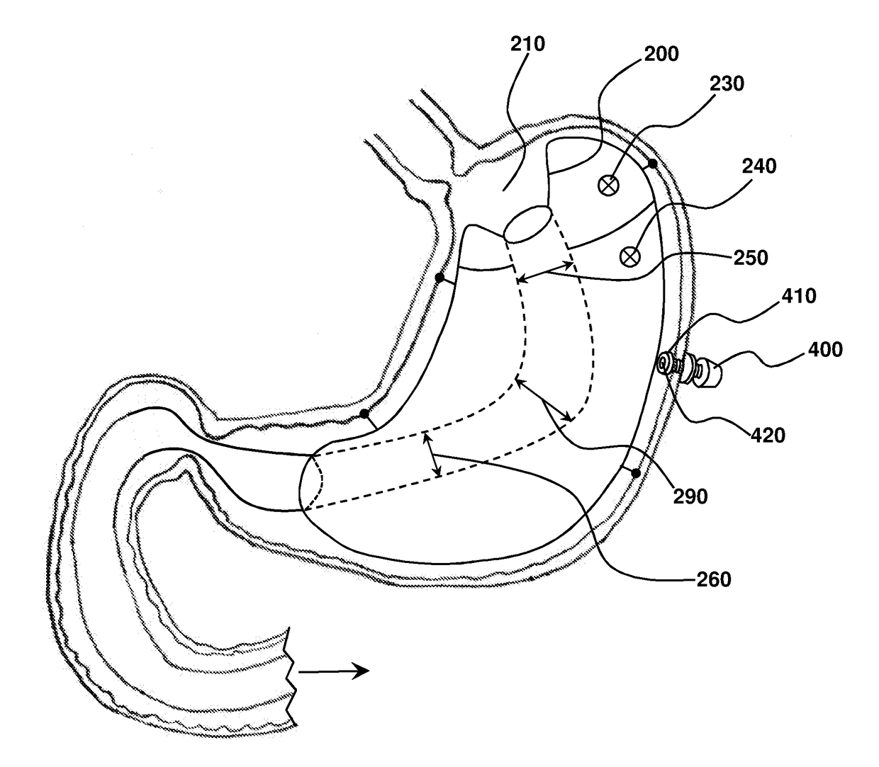 Sleeve-anchorable gastric balloon for weight loss