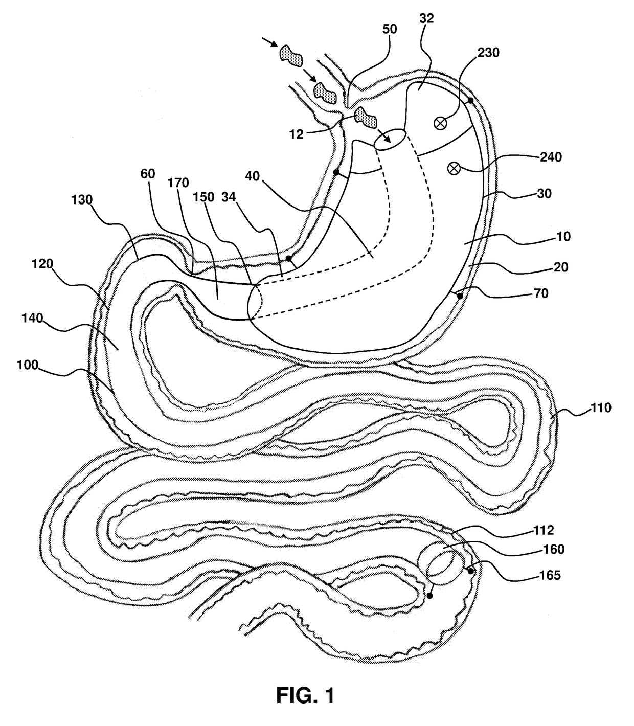 Sleeve-anchorable gastric balloon for weight loss