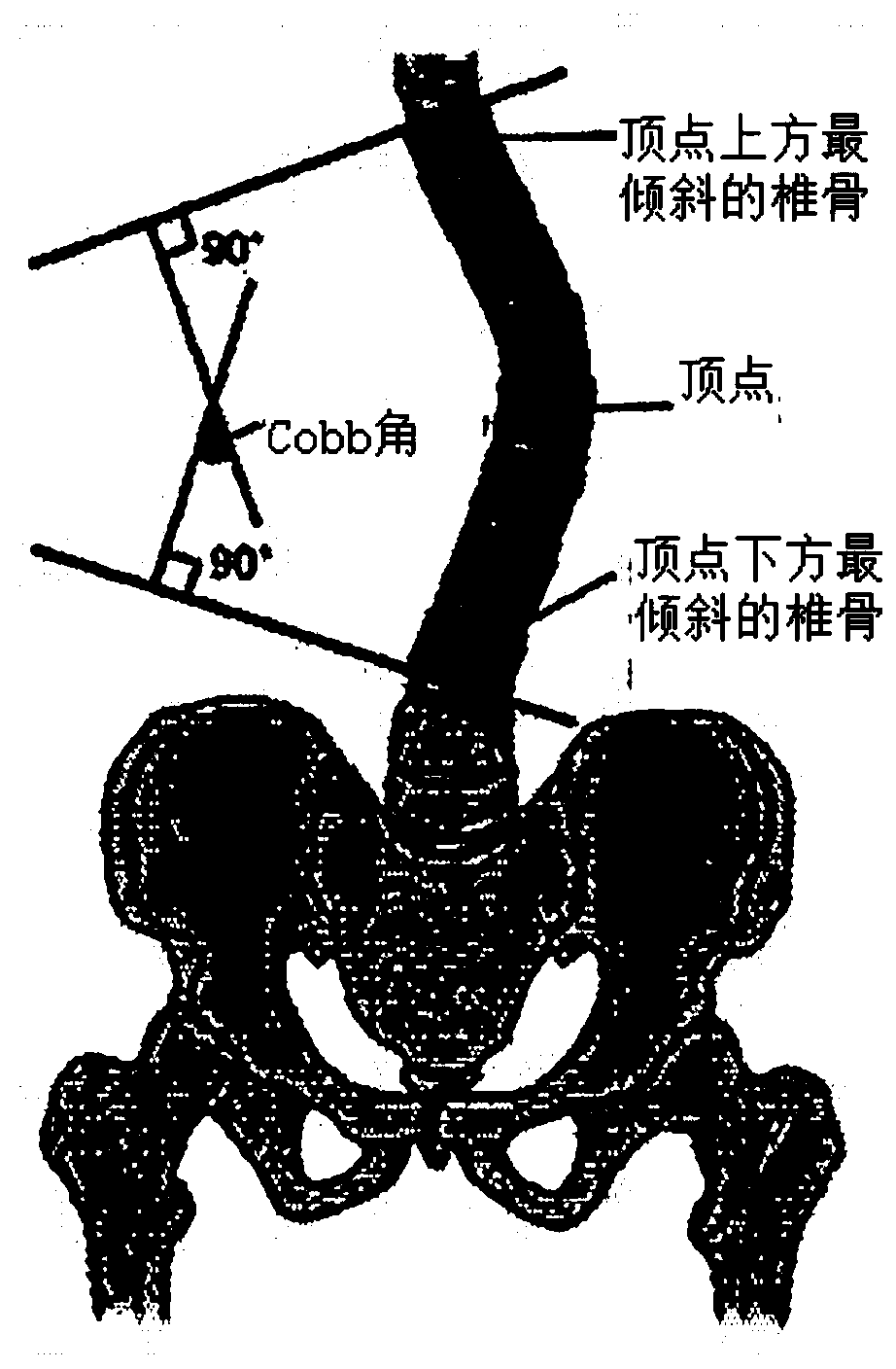 Device for examining degree of scoliosis