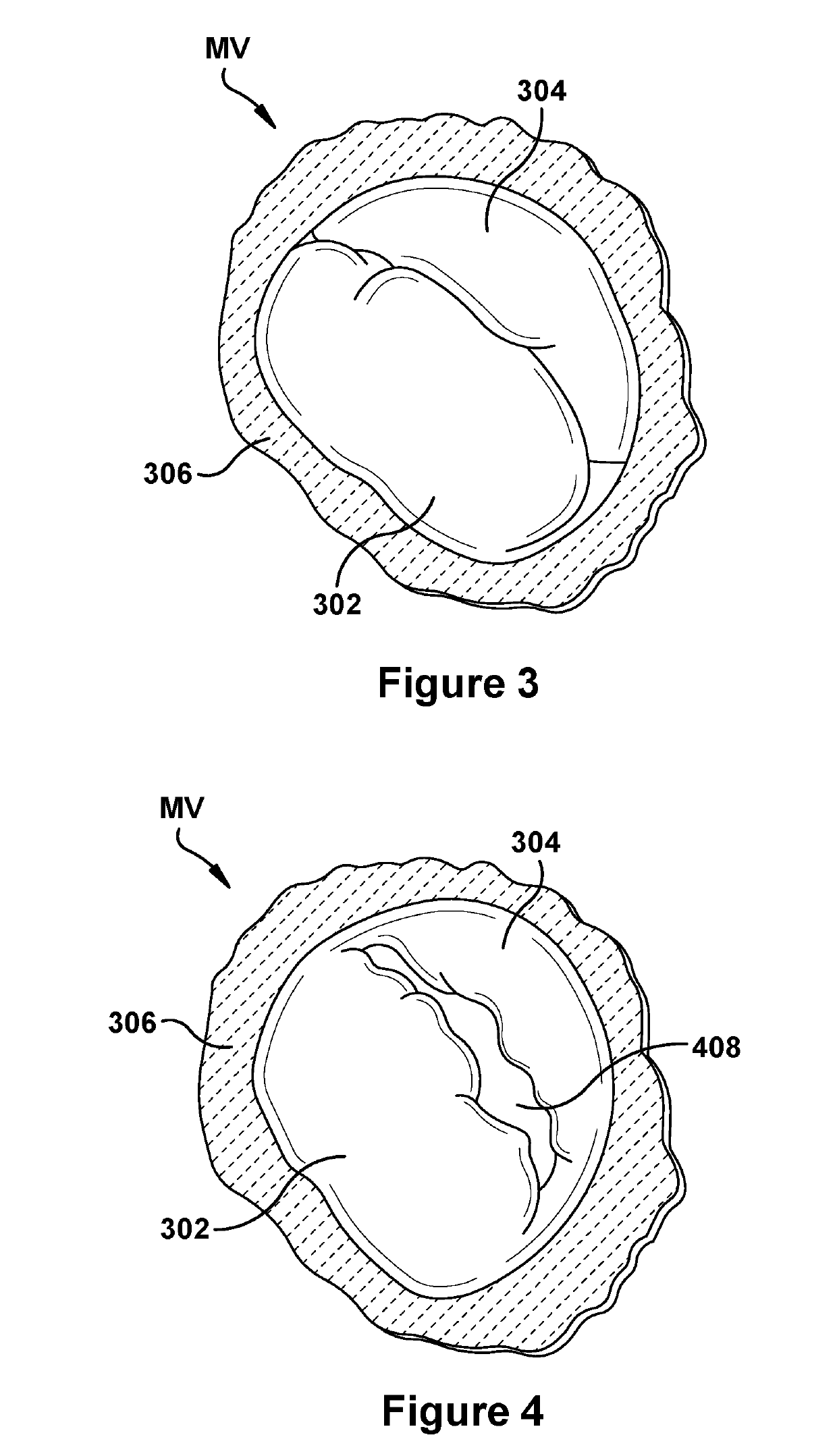 Native valve repair devices and procedures