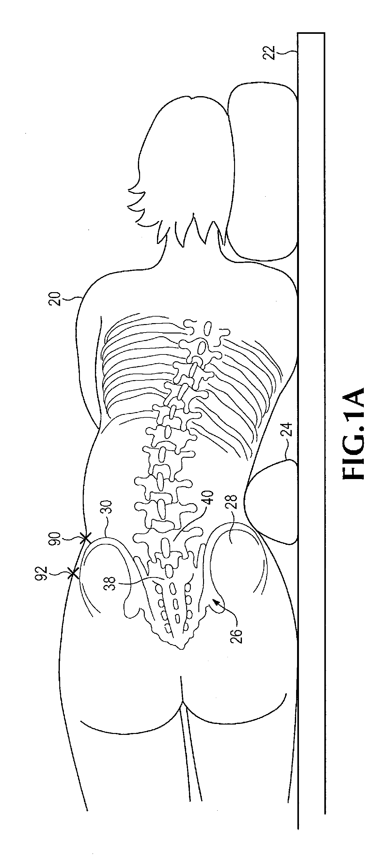 Insertion device for use during retroperitoneal lateral insertion of spinal implants